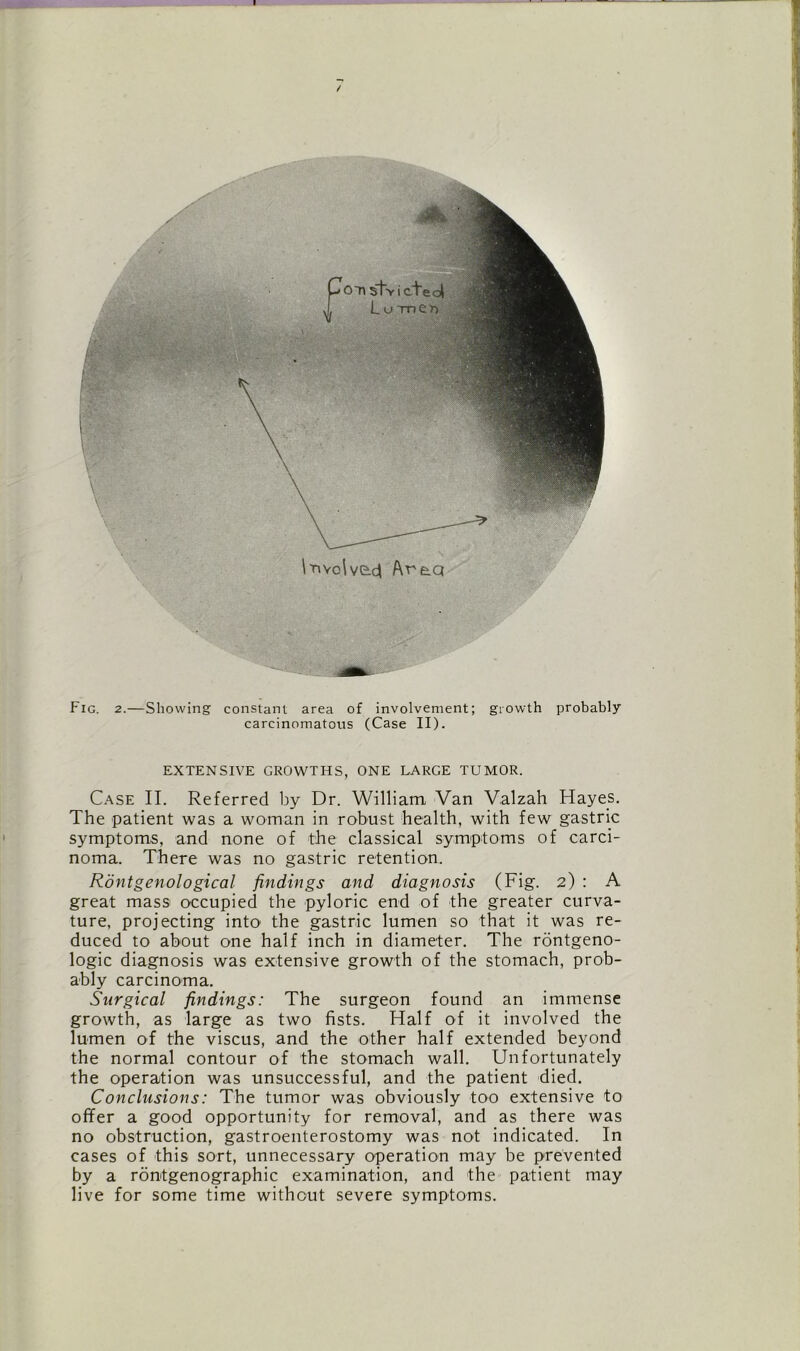 / < \T\voWe.d Area Fig. 2.—Showing constant area of involvement; growth probably carcinomatous (Case II). EXTENSIVE GROWTHS, ONE LARGE TUMOR. Case II. Referred by Dr. William Van Valzah Hayes. The patient was a woman in robust health, with few gastric symptoms, and none of the classical symptoms of carci- noma. There was no gastric retention. Rontgenological findings and diagnosis (Fig. 2) : A great mass occupied the pyloric end of the greater curva- ture, projecting into the gastric lumen so that it was re- duced to about one half inch in diameter. The rontgeno- logic diagnosis was extensive growth of the stomach, prob- ably carcinoma. Surgical findings: The surgeon found an immense growth, as large as two fists. Half of it involved the lumen of the viscus, and the other half extended beyond the normal contour of the stomach wall. Unfortunately the operation was unsuccessful, and the patient died. Conclusions: The tumor was obviously too extensive to offer a good opportunity for removal, and as there was no obstruction, gastroenterostomy was not indicated. In cases of this sort, unnecessary operation may be prevented by a rdntgenographic examination, and the patient may live for some time without severe symptoms.