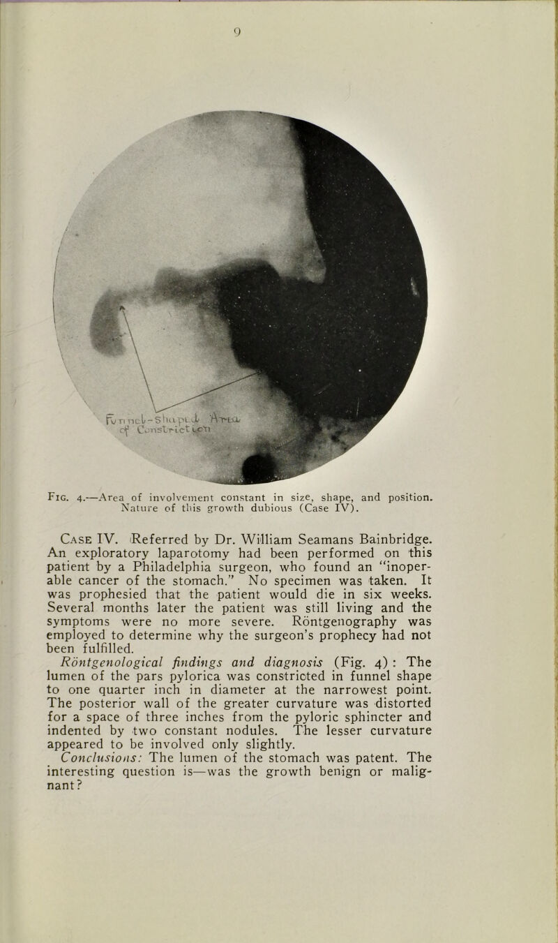 Fig. 4.—Area of involvement constant in size, shape, and position. Nature of this growth dubious (Case IV). Case IV. Referred by Dr. William Seamans Bainbridge. An exploratory laparotomy had been performed on this patient by a Philadelphia surgeon, who found an “inoper- able cancer of the stomach.” No specimen was taken. It was prophesied that the patient would die in six weeks. Several months later the patient was still living and the symptoms were no more severe. Rontgenography was employed to determine why the surgeon’s prophecy had not been fulfilled. Rontgenological findings and diagnosis (Fig. 4) : The lumen of the pars pylorica was constricted in funnel shape to one quarter inch in diameter at the narrowest point. The posterior wall of the greater curvature was distorted for a space of three inches from the pyloric sphincter and indented by two constant nodules. The lesser curvature appeared to be involved only slightly. Conclusions: The lumen of the stomach was patent. The interesting question is—was the growth benign or malig- nant ? 1