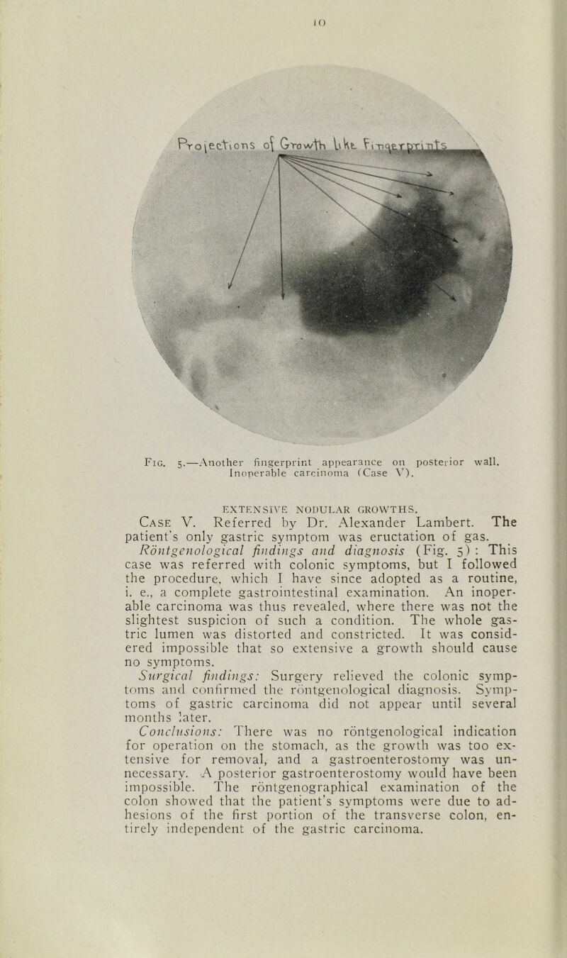 Fig. 5.—Another fingerprint appearance on posterior wall. Inoperable carcinoma (Case V). EXTENSIVE NODULAR GROWTHS. Case V. Referred by Dr. Alexander Lambert. The patient's only gastric symptom was eructation of gas. Rdntgcnological findings and diagnosis (Fig. 5) : This case was referred with colonic symptoms, but I followed the procedure, which I have since adopted as a routine, i. e., a complete gastrointestinal examination. An inoper- able carcinoma was thus revealed, where there was not the slightest suspicion of such a condition. The whole gas- tric lumen was distorted and constricted. It was consid- ered impossible that so extensive a growth should cause no symptoms. Surgical findings: Surgery relieved the colonic symp- toms and confirmed the rontgenological diagnosis. Symp- toms of gastric carcinoma did not appear until several months later. Conclusions: There was no rontgenological indication for operation on the stomach, as the growth was too ex- tensive for removal, and a gastroenterostomy was un- necessary. A posterior gastroenterostomy would have been impossible. The rontgenographical examination of the colon showed that the patient's symptoms were due to ad- hesions of the first portion of the transverse colon, en- tirely independent of the gastric carcinoma.