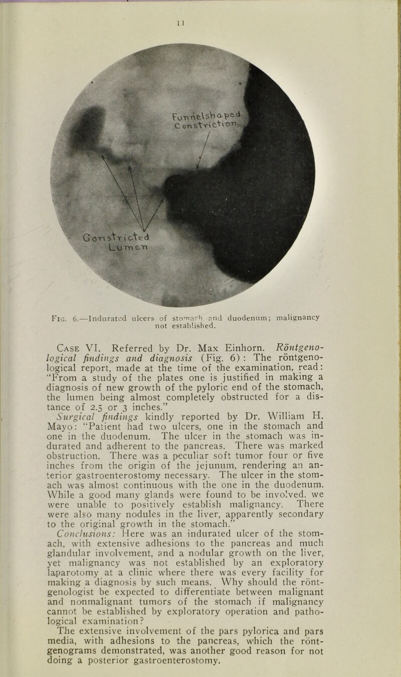 Fig. 6.—Indurated ulcers of stomach pud duodenum; malignancy not established. Case VI. Referred by Dr. Max Einhorn. Rontgeno- logical findings and diagnosis (Fig. 6) : The rontgeno- logical report, made at the time of the examination, read: “From a study of the plates one is justified in making a diagnosis of new growth of the pyloric end of the stomach, the lumen being almost completely obstructed for a dis- tance of 2.5 or 3 inches.” Surgical findings kindly reported by Dr. William IT. Mayo: “Patient had two ulcers, one in the stomach and one in the duodenum. The ulcer in the stomach was in- durated and adherent to the pancreas. There was marked obstruction. There was a peculiar soft tumor four or five inches from the origin of the jejunum, rendering an an- terior gastroenterostomy necessary. The ulcer in the stom- ach was almost continuous with the one in the duodenum. While a good many glands were found to be involved, we were unable to positively establish malignancy. There were also many nodules in the liver, apparently secondary to the original growth in the sto-mach.” Conclusions: Here was an indurated ulcer of the stom- ach, with extensive adhesions to the pancreas and much glandular involvement, and a nodular growth on the liver, yet malignancy was not established by an exploratory laparotomy at a clinic where there was every facility for making a diagnosis by such means. Why should the ront- genologist be expected to differentiate between malignant and nonmalignant tumors of the stomach if malignancy cannot be established by exploratory operation and patho- logical examination? The extensive involvement of the pars pylorica and pars media, with adhesions to the pancreas, which the ront- genograms demonstrated, was another good reason for not doing a posterior gastroenterostomy.