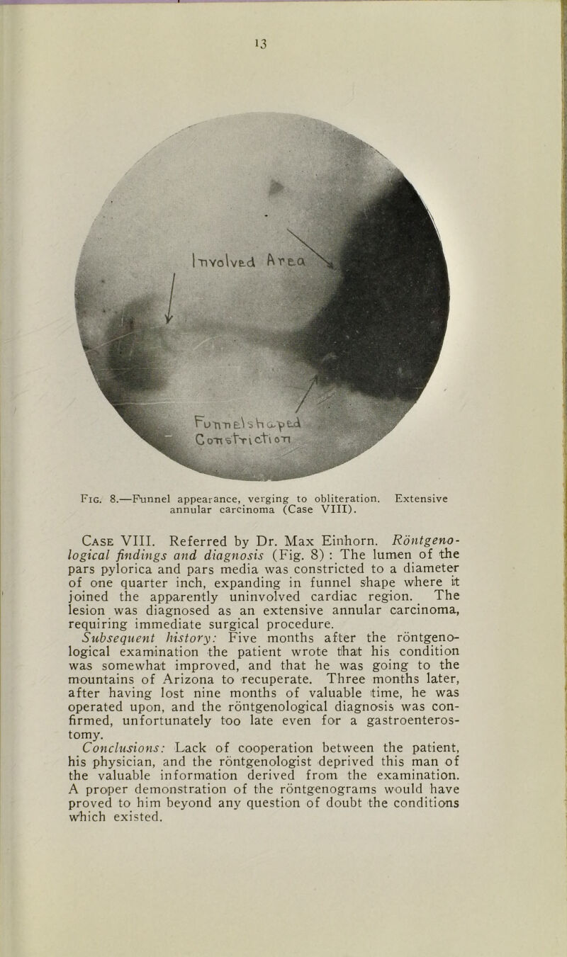 Fig. 8.—F'unnel appearance, verging to obliteration. Extensive annular carcinoma (Case VIII). Case VIII. Referred by Dr. Max Einhorn. Rontgeno- logical findings and diagnosis (Fig. 8) : The lumen of the pars pylorica and pars media was constricted to a diameter of one quarter inch, expanding in funnel shape where it joined the apparently uninvolved cardiac region. The lesion was diagnosed as an extensive annular carcinoma, requiring immediate surgical procedure. Subsequent history: Five months after the rontgeno- logical examination the patient wrote that his condition was somewhat improved, and that he was going to the mountains of Arizona to recuperate. Three months later, after having lost nine months of valuable time, he was operated upon, and the rontgenological diagnosis was con- firmed, unfortunately too late even for a gastroenteros- tomy. Conclusions: Lack of cooperation between the patient, his physician, and the rontgenologist deprived this man of the valuable information derived from the examination. A proper demonstration of the rontgenograms would have proved to him beyond any question of doubt the conditions wFich existed.