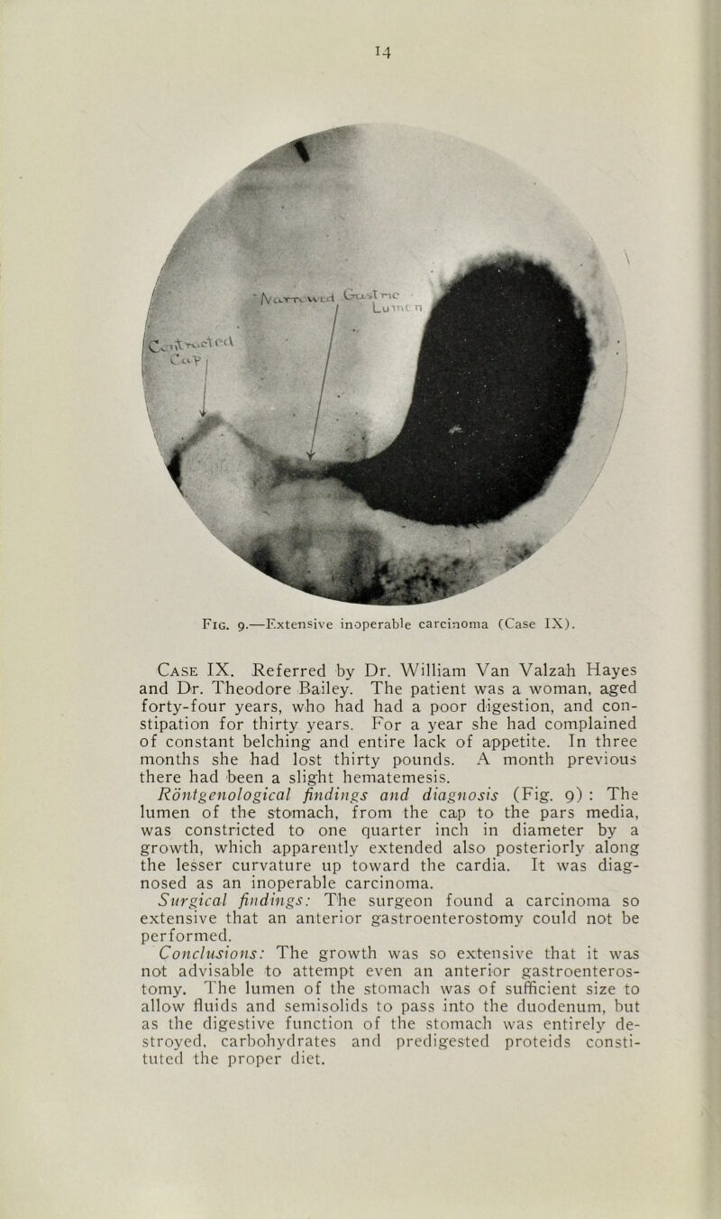Fig. 9.—Extensive inoperable carcinoma (Case IX). Case IX. Referred by Dr. William Van Valzah Hayes and Dr. Theodore Bailey. The patient was a woman, aged forty-four years, who had had a poor digestion, and con- stipation for thirty years. For a year she had complained of constant belching and entire lack of appetite. In three months she had lost thirty pounds. A month previous there had been a slight hematemesis. Rontgenological findings and diagnosis (Fig. 9) : The lumen of the stomach, from the cap to the pars media, was constricted to one quarter inch in diameter by a growth, which apparently extended also posteriorly along the lesser curvature up toward the cardia. It was diag- nosed as an inoperable carcinoma. Surgical findings: The surgeon found a carcinoma so extensive that an anterior gastroenterostomy could not be performed. Conclusions: The growth was so extensive that it was not advisable to attempt even an anterior gastroenteros- tomy. The lumen of the stomach was of sufficient size to allow fluids and semisolids to pass into the duodenum, but as the digestive function of the stomach was entirel)'- de- stroyed. carbohydrates and predigested proteids consti- tuted the proper diet.