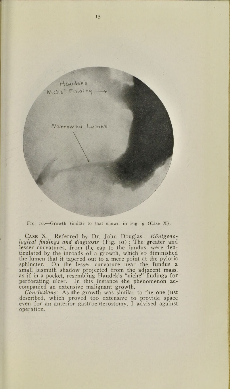 *S§HS \-\ctudeV s ' t\/ \ cVi £  FiTidiTi(| > Narrow e.d Lutde-Ti Fig. io.—Growth similar to that shown in Fig. g (Case X). Case X. Referred by Dr. John Douglas. Rontgeno- logical findings and diagnosis (Fig. io) : The greater and lesser curvatures, from the cap to the fundus, were den- ticulated by the inroads of a growth, which so diminished the lumen that it tapered out to a mere point at the pyloric sphincter. On the lesser curvature near the fundus a small bismuth shadow projected from the adjacent mass, as if in a pocket, resembling Flaudek’s “niche” findings for perforating ulcer. In this instance the phenomenon ac- companied an extensive malignant growth. Conclusions: As the growth was similar to the one just described, which proved too extensive to provide space even for an anterior gastroenterostomy, I advised against operation.