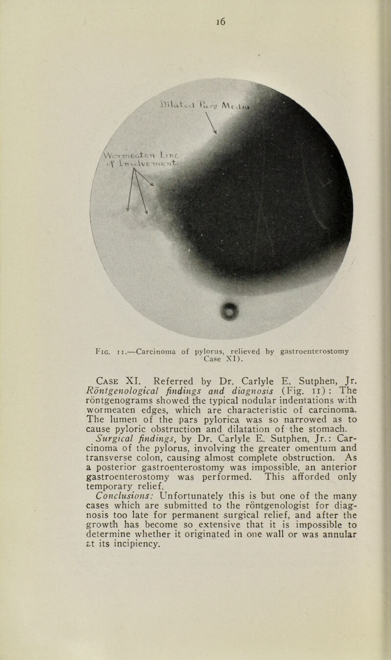 Fig. ix.—Carcinoma of pylorus, relieved by gastroenterostomy Case XI). Case XI. Referred by Dr. Carlyle E. Sutphen, Jr. Rontgenological findings and diagnosis (Fig. n) : The rontgenograms showed the typical nodular indentations with wormeaten edges, which are characteristic of carcinoma. The lumen of the pars pylorica was so narrowed as to cause pyloric obstruction and dilatation of the stomach. Surgical findings, by Dr. Carlyle E. Sutphen, Jr.: Car- cinoma of the pylorus, involving the greater omentum and transverse colon, causing almost complete obstruction. As a posterior gastroenterostomy was impossible, an anterior gastroenterostomy was performed. This afforded only temporary relief. Conclusions: Unfortunately this is but one of the many cases which are submitted to the rontgenologist for diag- nosis too late for permanent surgical relief, and after the growth has become so extensive that it is impossible to determine whether it originated in one wall or was annular at its incipiency.