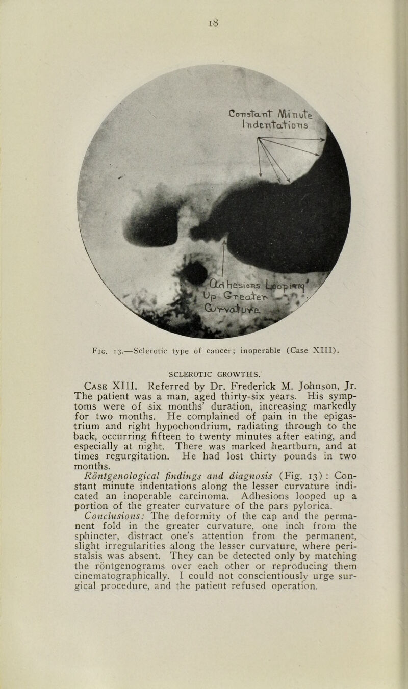 Fig. 13.—Sclerotic type of cancer; inoperable (Case XIII). SCLEROTIC GROWTHS. Case XIII. Referred by Dr. Frederick M. Johnson, Jr. The patient was a man, aged thirty-six years. His symp- toms were of six months’ duration, increasing markedly for two months. He complained of pain in the epigas- trium and right hypochondrium, radiating through to the back, occurring fifteen to twenty minutes after eating, and especially at night. There was marked heartburn, and at times regurgitation. He had lost thirty pounds in two months. Rontgenological findings and diagnosis (Fig. 13) : Con- stant minute indentations along the lesser curvature indi- cated an inoperable carcinoma. Adhesions looped up a portion of the greater curvature of the pars pylorica. Conclusions: The deformity of the cap and the perma- nent fold in the greater curvature, one inch from the sphincter, distract one’s attention from the permanent, slight irregularities along the lesser curvature, where peri- stalsis was absent. They can be detected only by matching the rontgenograms over each other or reproducing them cinematographically. I could not conscientiously urge sur- gical procedure, and the patient refused operation.