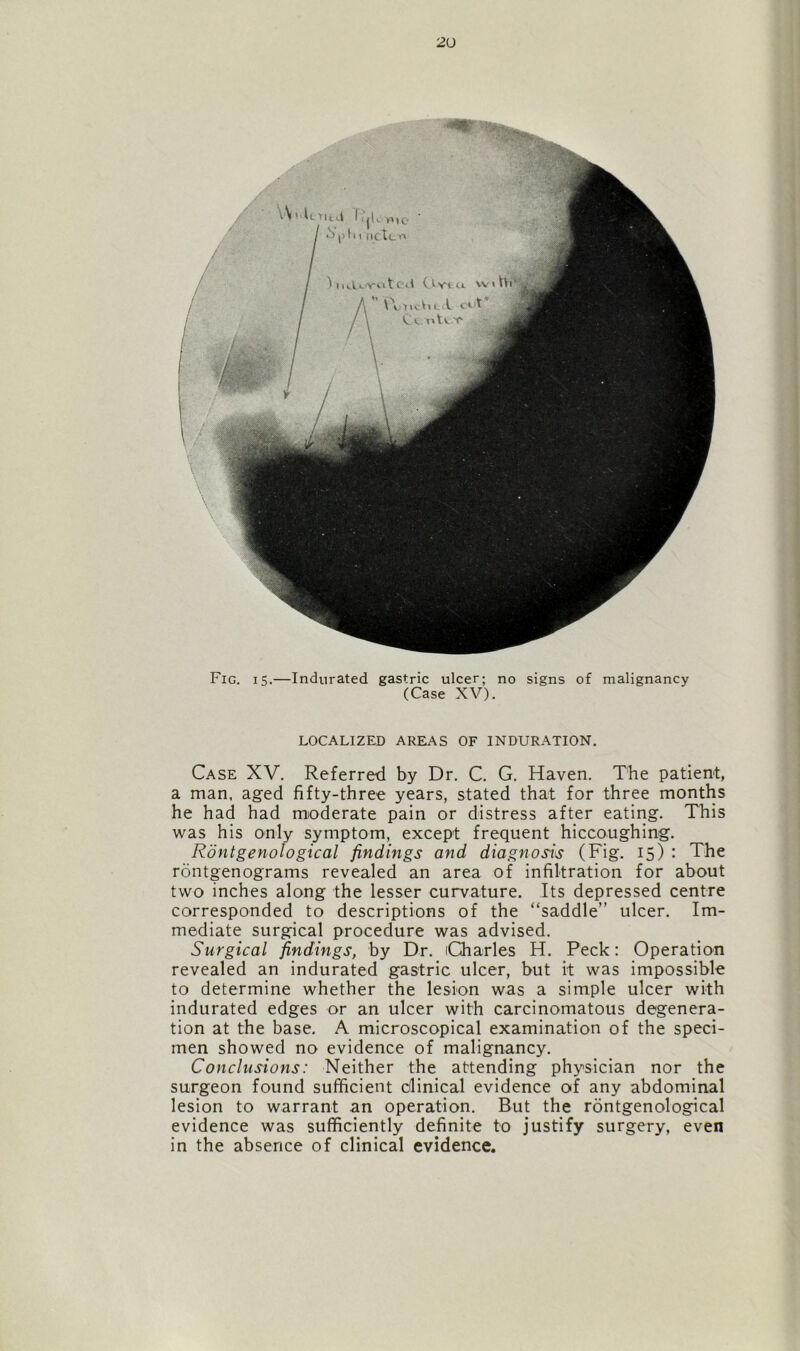 Fig. 15.—Indurated gastric ulcer; no signs of malignancy (Case XV). LOCALIZED AREAS OF INDURATION. Case XV. Referred by Dr. C. G. Haven. The patient, a man, aged fifty-three years, stated that for three months he had had moderate pain or distress after eating. This was his only symptom, except frequent hiccoughing. Rontgenological findings and diagnosis (Fig. 15) : The rontgenograms revealed an area of infiltration for about two inches along the lesser curvature. Its depressed centre corresponded to descriptions of the “saddle” ulcer. Im- mediate surgical procedure was advised. Surgical findings, by Dr. Charles H. Peck: Operation revealed an indurated gastric ulcer, but it was impossible to determine whether the lesion was a simple ulcer with indurated edges or an ulcer with carcinomatous degenera- tion at the base. A microscopical examination of the speci- men showed no evidence of malignancy. Conclusions: Neither the attending physician nor the surgeon found sufficient clinical evidence of any abdominal lesion to warrant an operation. But the rontgenological evidence was sufficiently definite to justify surgery, even in the absence of clinical evidence.