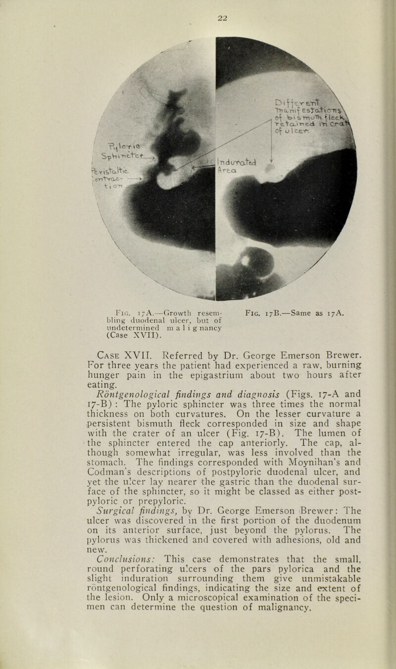 Fig. 17A.—Growth reseni- Fig. 17B.—Same as 17A. 1)1 ing duodenal ulcer, but of undetermined m a 1 i g nancy (Case XVII). Case XVII. Referred by Dr. George Emerson Brewer. For three years the patient had experienced a raw, burning hunger pain in the epigastrium about two hours after eating. Rontgenological findings and diagnosis (Figs. 17-A and 17-B) : The pyloric sphincter was three times the normal thickness on both curvatures. On the lesser curvature a persistent bismuth fleck corresponded in size and shape with the crater of an ulcer (Fig. 17-B). The lumen of the sphincter entered the cap anteriorly. The cap, al- though somewhat irregular, was less involved than the stomach. The findings corresponded with Moynihan's and Codman's descriptions of postpyloric duodenal ulcer, and yet the ulcer lay nearer the gastric than the duodenal sur- face of the sphincter, so it might be classed as either post- pyloric or prepyloric. Surgical findings, by Dr. George Emerson Brewer: The ulcer was discovered in the first portion of the duodenum on its anterior surface, just beyond the pylorus. The pylorus was thickened and covered with adhesions, old and new. Conclusions: This case demonstrates that the small, round perforating ulcers of the pars pylorica and the slight induration surrounding them give unmistakable rontgenological findings, indicating the size and extent of the lesion. Only a microscopical examination of the speci- men can determine the question of malignancy.