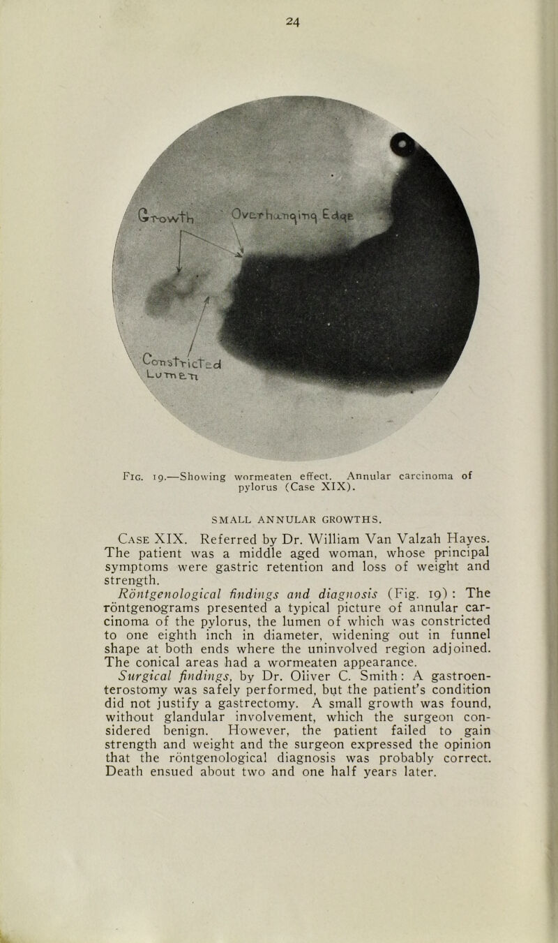 (^T-owt’h Ovarhx'nc^i-ncj £do(fc C'cTi'S’l’flC Lutr> e.Tt Fig. 19.—Showing wormeaten effect. Annular carcinoma of pylorus (Case XIX). SMALL ANNULAR GROWTHS. Case XIX. Referred by Dr. William Van Valzah Hayes. The patient was a middle aged woman, whose principal symptoms were gastric retention and loss of weight and strength. Rontgenological findings and diagnosis (Fig. 19) : The rontgenograms presented a typical picture of annular car- cinoma of the pylorus, the lumen of which was constricted to one eighth inch in diameter, widening out in funnel shape at both ends where the uninvolved region adjoined. The conical areas had a wormeaten appearance. Surgical findings, by Dr. Oliver C. Smith : A gastroen- terostomy was safely performed, but the patient’s condition did not justify a gastrectomy. A small growth was found, without glandular involvement, which the surgeon con- sidered benign. However, the patient failed to gain strength and weight and the surgeon expressed the opinion that the rontgenological diagnosis was probably correct. Death ensued about two and one half years later.