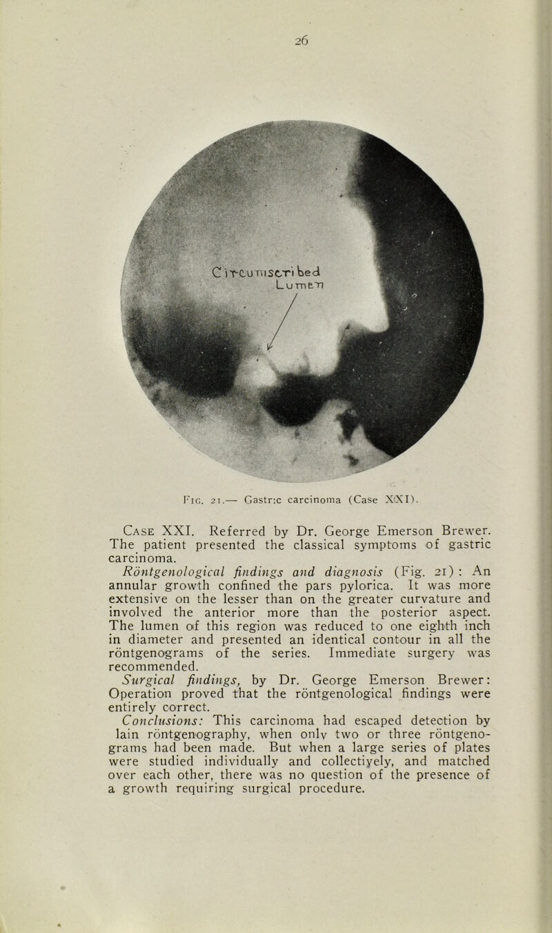 Case XXI. Referred by Dr. George Emerson Brewer. The patient presented the classical symptoms of gastric carcinoma. Rontgenological findings and diagnosis (Fig. 21) : An annular growth confined the pars pylorica. It was more extensive on the lesser than on the greater curvature and involved the anterior more than the posterior aspect. The lumen of this region was reduced to one eighth inch in diameter and presented an identical contour in all the rontgenograms of the series. Immediate surgery was recommended. Surgical findings, by Dr. George Emerson Brewer: Operation proved that the rontgenological findings were entirely correct. Conclusions: This carcinoma had escaped detection by lain rontgenography, when only two or three rontgeno- grams had been made. But when a large series of plates were studied individually and collectiyely, and matched over each other, there was no question of the presence of a growth requiring surgical procedure.