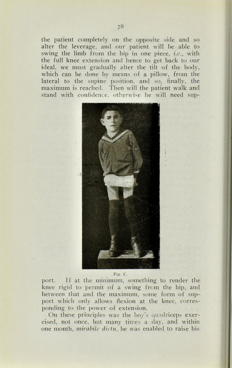 7S the patient completely on the opposite side and so alter the leverage, and our patient will he able to swing the limb from the hip in one piece, i.c., with the full knee extension and hence to get back to our ideal, we must gradually alter the tilt of the body, which can be done by means of a pillow, from the lateral to the supine position, and so, finally, the maximum is reached. Then will the patient walk and stand with confidence, otherwise he will need sup- Fi.tr. c. port. If at the minimum, something to render the knee rigid to permit of a swing from the hip, and between that and the maximum, some form of sup- port which only allows flexion at the knee, corres- ponding to the power of extension. On these principles was the boy's quadriceps exer- cised, not once, but many times a day, and within one month, mirabilc dictu, he was enabled to raise his