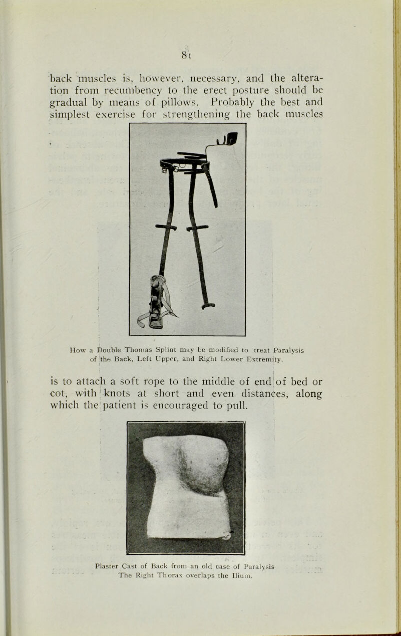 back muscles is, however, necessary, and the altera- tion from recumbency to the erect posture should be gradual by means of pillows. Probably the best and simplest exercise for strengthening the back muscles How a Double Thomas Splint may be modified to treat Paralysis of the Back, Left Upper, and Right Lower Extremity. is to attach a soft rope to the middle of end of bed or cot, with knots at short and even distances, along which the patient is encouraged to pull. Plaster Cast of Back from an old case of Paralysis The Right Thorax overlaps the Ilium.