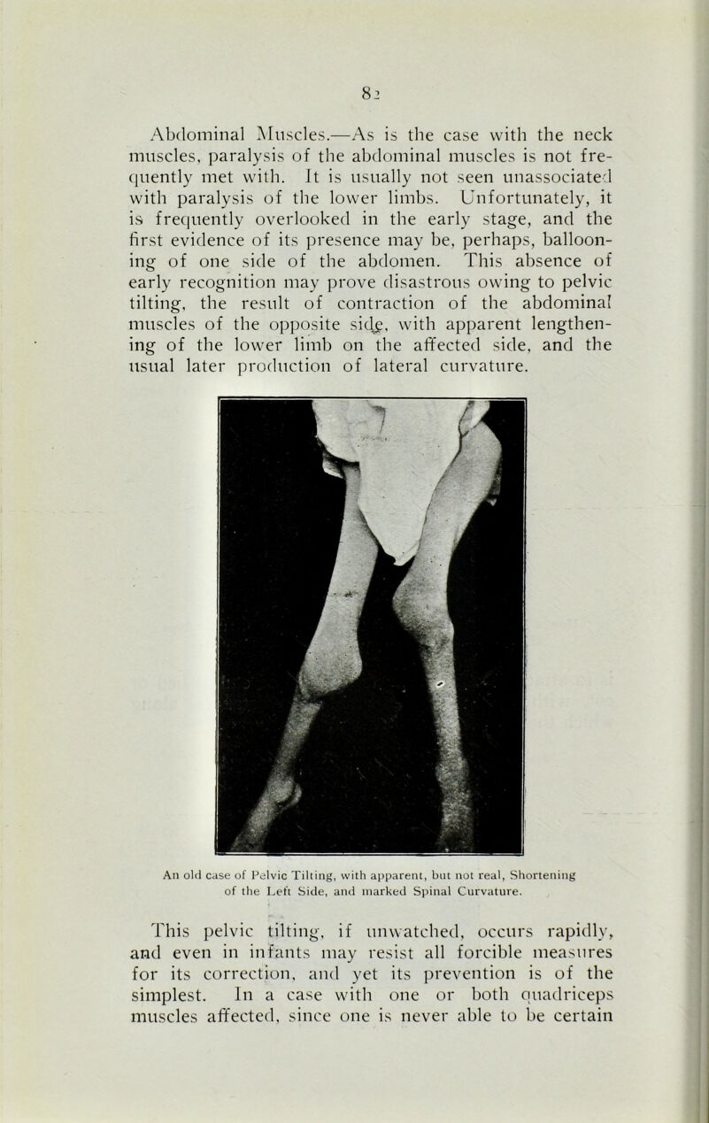 Abdominal Muscles.—As is the case with the neck muscles, paralysis of the abdominal muscles is not fre- quently met with. Jt is usually not seen unassociated with paralysis of the lower limbs. Unfortunately, it is frequently overlooked in the early stage, and the first evidence of its presence may be, perhaps, balloon- ing of one side of the abdomen. This absence of early recognition may prove disastrous owing to pelvic tilting, the result of contraction of the abdominal muscles of the opposite side, with apparent lengthen- ing of the lower limb on the affected side, and the usual later production of lateral curvature. An old case of Pelvic Tilting, with apparent, but not real, Shortening of the Left Side, and marked Spinal Curvature. This pelvic tilting, if unwatched, occurs rapidly, and even in infants may resist all forcible measures for its correction, and yet its prevention is of the simplest. In a case with one or both quadriceps muscles affected, since one is never able to be certain