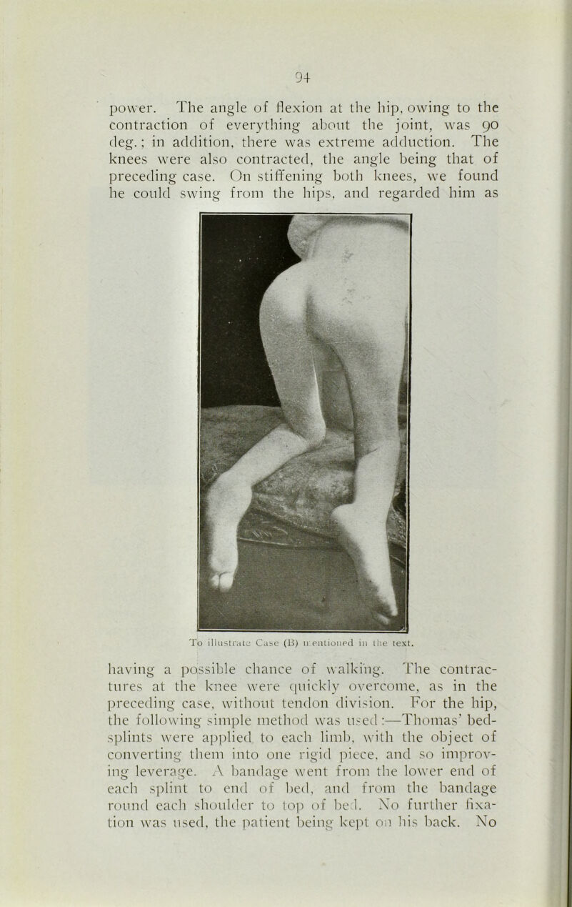 power. The angle of flexion at the hip, owing to the contraction of everything about the joint, was 90 deg.; in addition, there was extreme adduction. The knees were also contracted, the angle being that of preceding case. On stiffening both knees, we found he could swing from the hips, and regarded him as To illustrate Case (B) n pinioned in the text. having a possible chance of walking. The contrac- tures at the knee were quickly overcome, as in the preceding case, without tendon division. For the hip, the following simple method was used:—Thomas’ bed- splints were applied to each limb, with the object of converting them into one rigid piece, and so improv- ing leverage. A bandage went from the lower end of each splint to end of bed, and from the bandage round each shoulder to top of he 1. No further fixa- tion was used, the patient being kept on his back. No