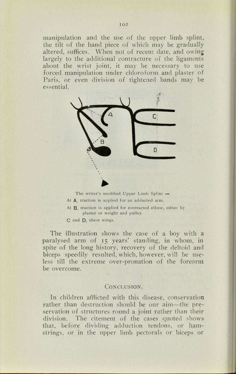 manipulation and the use of the upper limb splint, the tilt of the hand piece of which may be gradually altered, suffices. When not of recent date, and owing largely to the additional contracture of the ligaments about the wrist joint, it may be necessary to use forced manipulation under chloroform and plaster of Paris, or even division of tightened bands may be essential. ► The writer’s modified Upper Limb Splint — At A, traction is applied for an adducted arm. At B, traction is applied for contracted elbow, either by plaster or weight and pulley. C and D, chest wings. The illustration shows the case of a boy with a paralysed arm of 15 years’ standing, in whom, in spite of the long history, recovery of the deltoid and biceps speedily resulted, which, however, will be use- less till the extreme over-pronation of the forearm be overcome. Conclusion. T11 children afflicted with this disease, conservation rather than destruction should be our aim—the pre- servation of structures round a joint rather than their division. The citement of the cases quoted shows that, before dividing adduction tendons, or ham- strings, or in the upper limb pectorals or biceps or