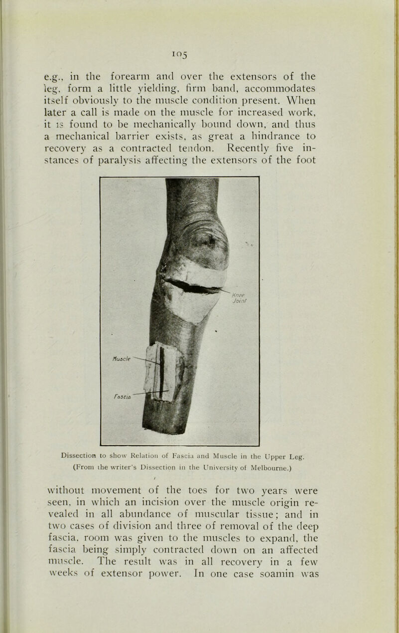 io5 e.g., in the forearm and over the extensors of the leg, form a little yielding, firm band, accommodates itself obviously to the muscle condition present. When later a call is made on the muscle for increased work, it is found to be mechanically bound down, and thus a mechanical barrier exists, as great a hindrance to recovery as a contracted tendon. Recently five in- stances of paralysis affecting the extensors of the foot Dissection to show Relation of Fascia and Muscle in the Upper Leg. (From ihe writer's Dissection in the University of Melbourne.) without movement of the toes for two years were seen, in which an incision over the muscle origin re- vealed in all abundance of muscular tissue; and in two cases of division and three of removal of the deep fascia, room was given to the muscles to expand, the fascia being simply contracted down on an affected muscle. The result was in all recovery in a few weeks of extensor power. In one case soamin was