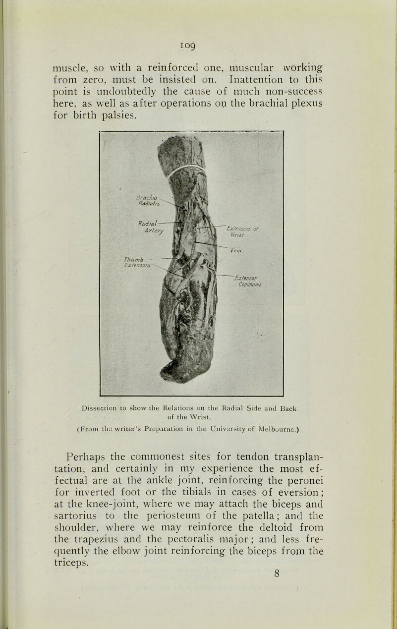 iog muscle, so with a reinforced one, muscular working from zero, must be insisted on. Inattention to this point is undoubtedly the cause of much non-success here, as well as after operations ou the brachial plexus for birth palsies. Dissection to show the Relations on the Radial Side and Back of the Wrist. (From the writer’s Preparation in the University of Melbourne.) Perhaps the commonest sites for tendon transplan- tation, and certainly in my experience the most ef- fectual are at the ankle joint, reinforcing the peronei for inverted foot or the tibials in cases of eversion; at the knee-joint, where we may attach the biceps and sartorius to the periosteum of the patella; and the shoulder, where we may reinforce the deltoid from the trapezius and the pectoralis major; and less fre- quently the elbow joint reinforcing the biceps from the triceps. 8