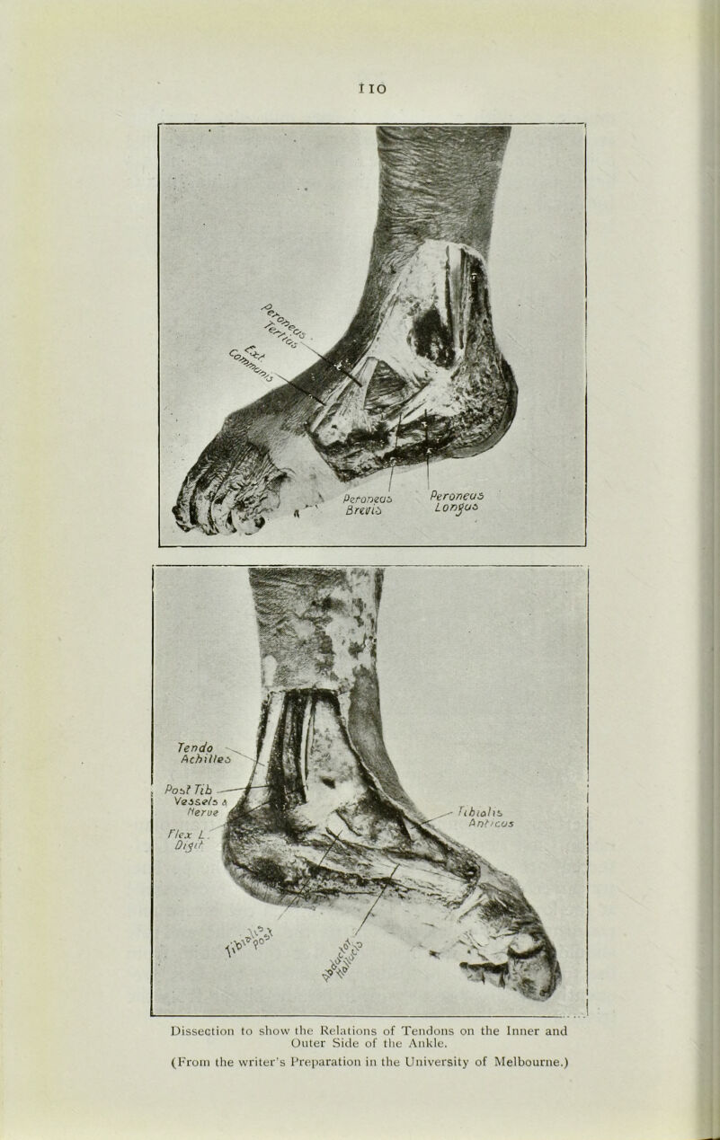 Peroneas Lonyuz Pzf-Qmut> Bni/id e Tendo Acbille Post Tib Vessels a Herve Tlex L. T(ktah*> Ant leas Dissection to show the Relations of Tendons on the Inner and Outer Side of the Ankle. (F rom the writer’s Preparation in the University of Melbourne.)