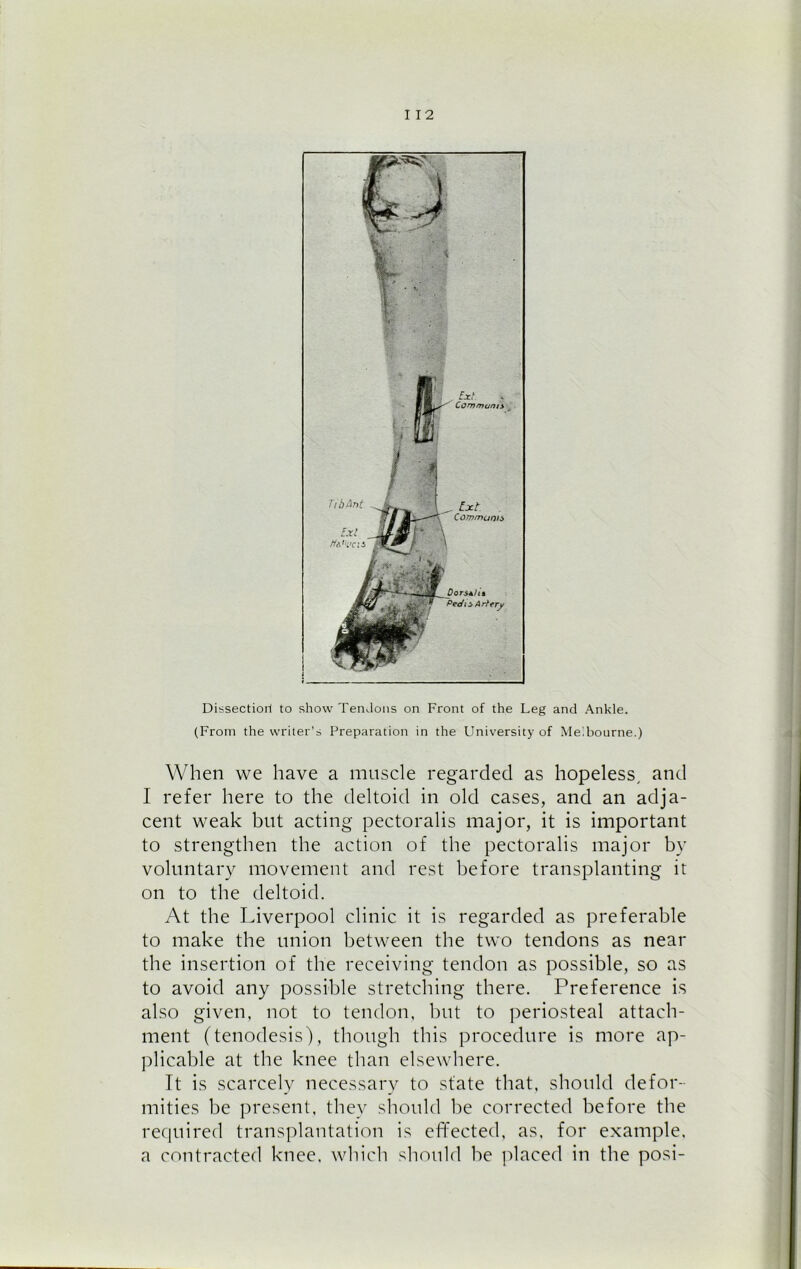 Dissectioil to show Tendons on Front of the Leg and Ankle. (From the writer’s Preparation in the University of Melbourne.) When we have a muscle regarded as hopeless, and I refer here to the deltoid in old cases, and an adja- cent weak but acting pectoralis major, it is important to strengthen the action of the pectoralis major by voluntary movement and rest before transplanting it on to the deltoid. At the Liverpool clinic it is regarded as preferable to make the union between the two tendons as near the insertion of the receiving tendon as possible, so as to avoid any possible stretching there. Preference is also given, not to tendon, but to periosteal attach- ment (tenodesis), though this procedure is more ap- plicable at the knee than elsewhere. It is scarcely necessary to state that, should defor- mities be present, they should be corrected before the required transplantation is effected, as, for example, a contracted knee, which should be placed in the posi-