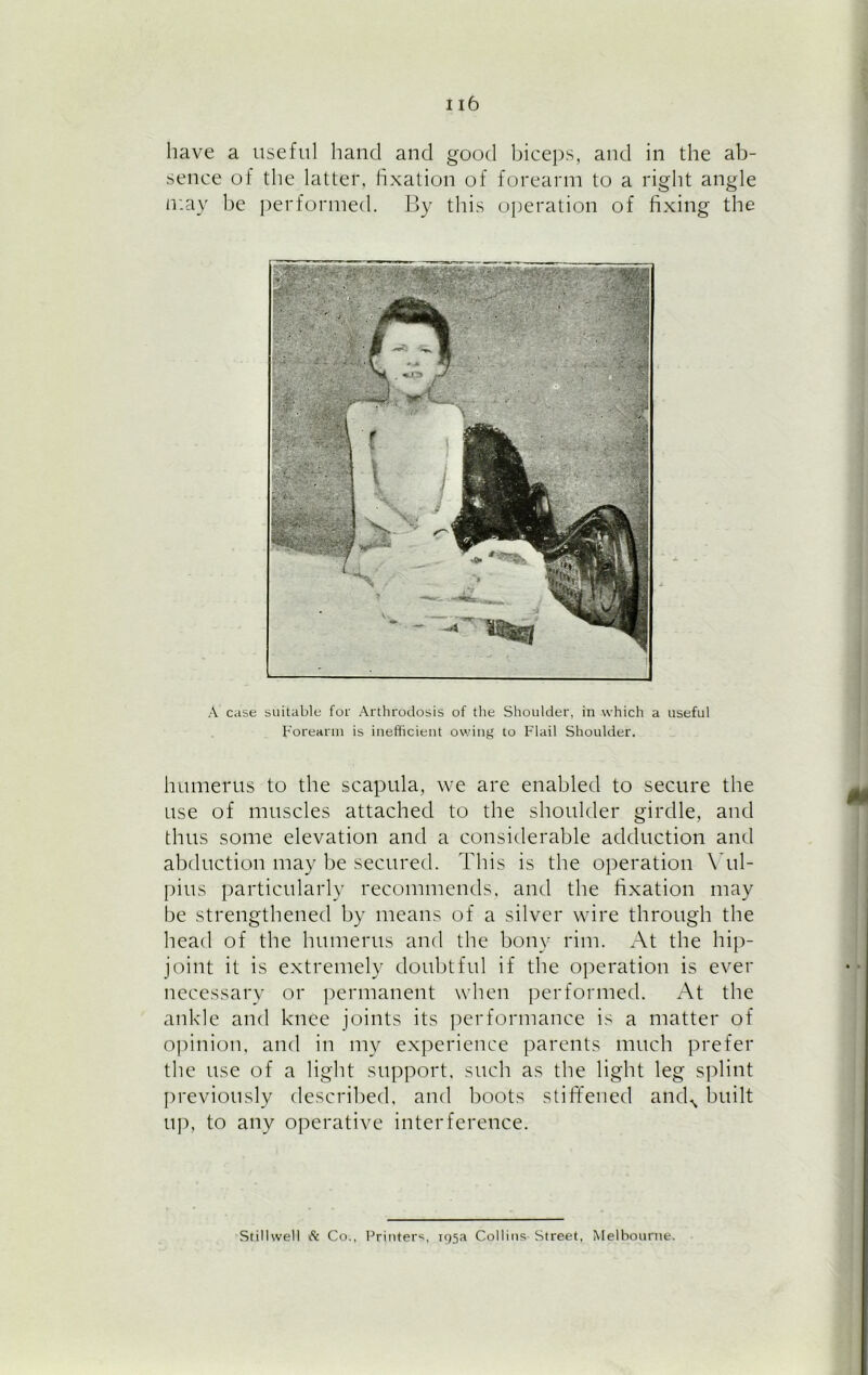 have a useful hand and good biceps, and in the ab- sence of the latter, fixation of forearm to a right angle may be performed. By this operation of fixing the A case suitable for Arthrodosis of the Shoulder, in which a useful Forearm is inefficient owing to Flail Shoulder. humerus to the scapula, we are enabled to secure the use of muscles attached to the shoulder girdle, and thus some elevation and a considerable adduction and abduction may be secured. This is the operation Yul- pius particularly recommends, and the fixation may be strengthened by means of a silver wire through the head of the humerus and the bony rim. At the hip- joint it is extremely doubtful if the operation is ever necessary or permanent when performed. At the ankle and knee joints its performance is a matter of opinion, and in my experience parents much prefer the use of a light support, such as the light leg splint previously described, and boots stiffened andN built up, to any operative interference. Stillwell & Co., Printers, 195a Collins Street, Melbourne.