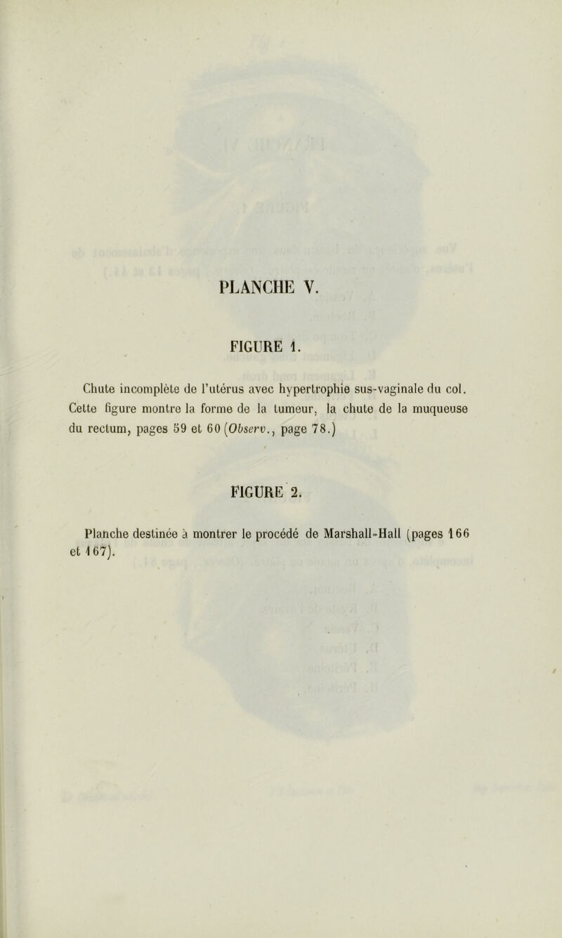 FIGURE 1. Chute incomplète de l’utérus avec hypertrophie sus-vaginale du col. Cette figure montre la forme de la tumeur, la chute de la muqueuse du rectum, pages 59 et 60 (Observ., page 78.) FIGURE 2. Planche destinée à montrer le procédé de Marshall-Hall (pages 166 et 167).