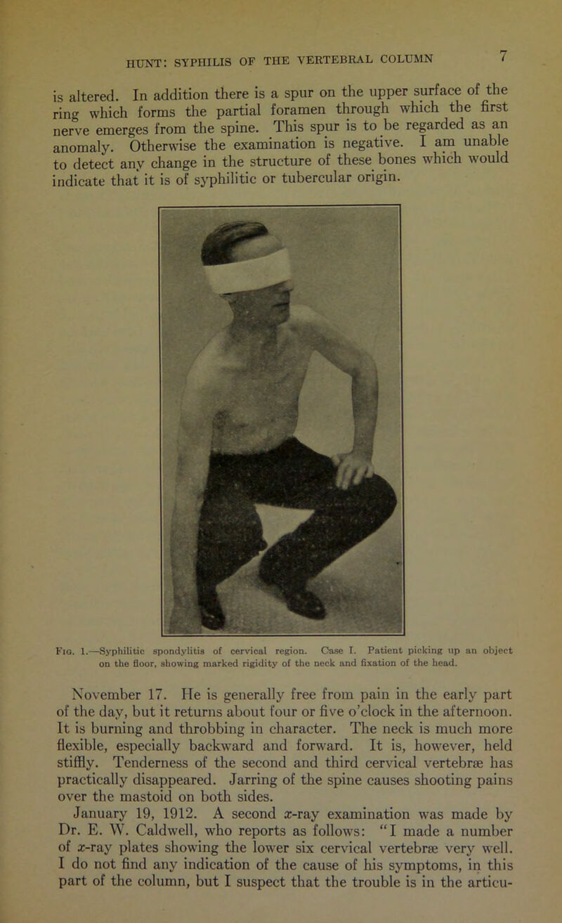 is altered. In addition there is a spur on the upper surface of the ring which forms tlie partial foramen through which the first nerve emerges from the spine. This spur is to be regarded as an anomaly. Otherwise the examination is negative. I am unable to detect any change in the structure of these bones which would indicate that it is of syphilitic or tubercular origin. Fiq. 1.—Syphilitic spondylitis of cervical region. Case I. Patient picking up an object on the floor, showing marked rigidity of the neck and fixation of the head. November 17. He is generally free from pain in the early part of the day, but it returns about four or five o’clock in the afternoon. It is burning and throbbing in character. The neck is much more flexible, especially backward and forward. It is, however, held stiffly. Tenderness of the second and third cervical vertebrae has practically disappeared. Jarring of the spine causes shooting pains over the mastoid on both sides. January 19, 1912. A second a:-ray examination was made by Dr. E. \V. Caldwell, who reports as follows: “I made a number of a:-ray plates showing the lower six cervical vertebrae very well. I do not find any indication of the cause of his symptoms, in this part of the column, but I suspect that the trouble is in the articu-