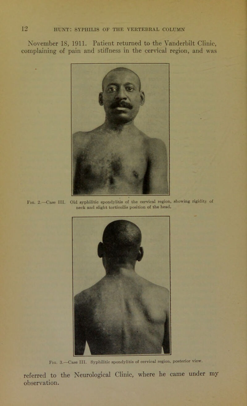 November 18, 1911. Patient returned to the Vanderbilt Clinic, complaining of pain and stiffness in the cerv'ical region, and was Tio. 2.—Ca«o III. Old ■yphilitic spondylitia of the cervical region* showing rigidity of neck and slight torticollis position of the head. Fig. 3.—Case III, Bjiihilitic spondylitis of cervical region, posterior view. referred to the Neurological Clinic, where he came under my observation.