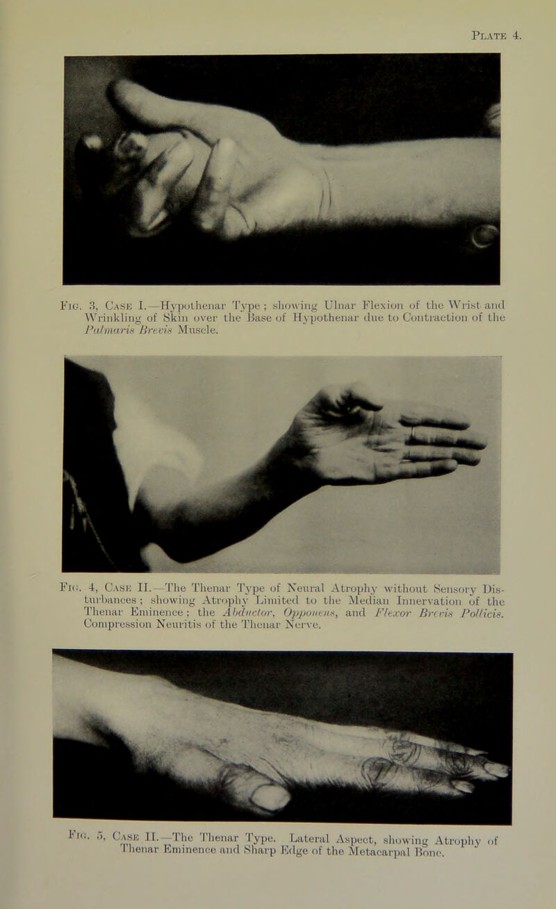 Pig. 3, Case I.—Hypothenar Type; showing Ulnar Flexion of the Wrist and Wrinkling of Skin over the Base of Hypothenar due to Contraction of the Pulmaris Brevis Muscle. Fig. 4, Case II.—The Thenar Type of Neural Atrophy without Sensory Dis- turbances ; showing Atrophy Limited to the Median Innervation of the Thenar Eminence; the Abductor, Opponent, and Flexor Brevis Pollicis. Compression Neuritis of the Thenar Nerve. Pro. 5, Case II.—The Thenar Type. Lateral Aspect, showing Atrophy of 1 henar Eminence and Sharp Edge of the Metacarpal Bone.