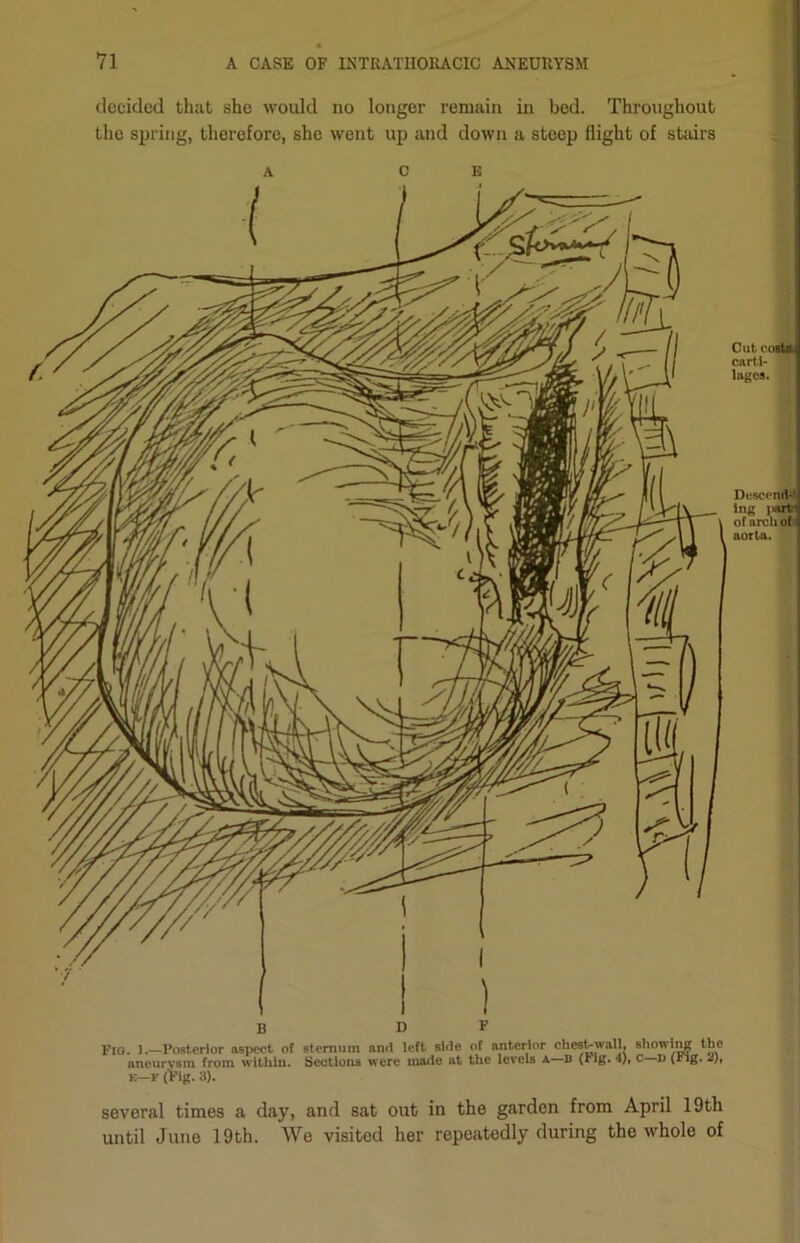 decided that she would no longer remain in bed. Throughout the spring, therefore, she went up and down a steep flight of stairs A c E Cut. costtti carti- lages. Descend-’1 Jng |«irtrsj of archofl aorta. several times a day, and sat out in the garden from April 19th until June 19th. We visited her repeatedly during the whole of