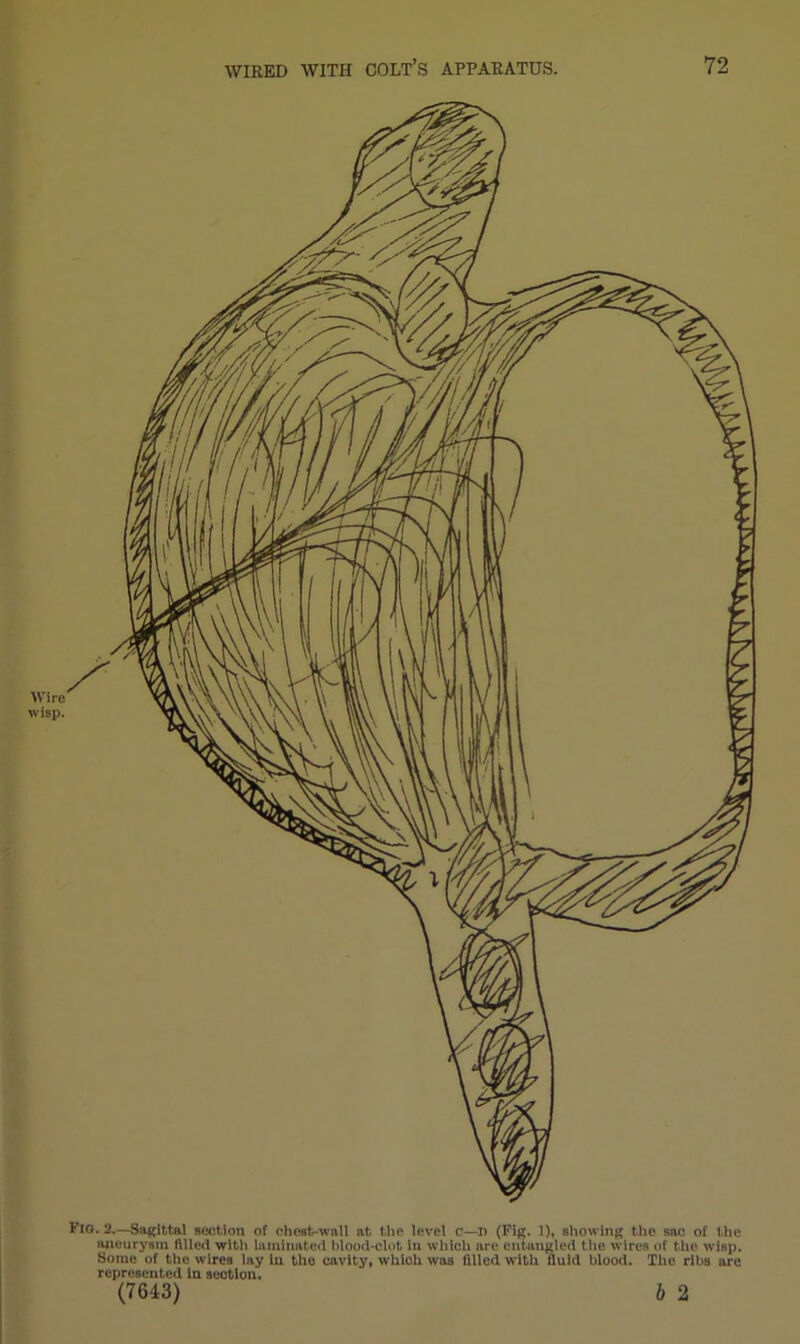 1?ig. 2.—Sagittal section of cheat-wall at the level c—r> (Fig. 1), showing the sac of the aneurysm filled with laminated blood-clot in which are entangled the wires of the wisp. Some of the wires lay in the cavity, which was filled with lluid blood. The ribs arc represented in section. (7613) b 2 ■w