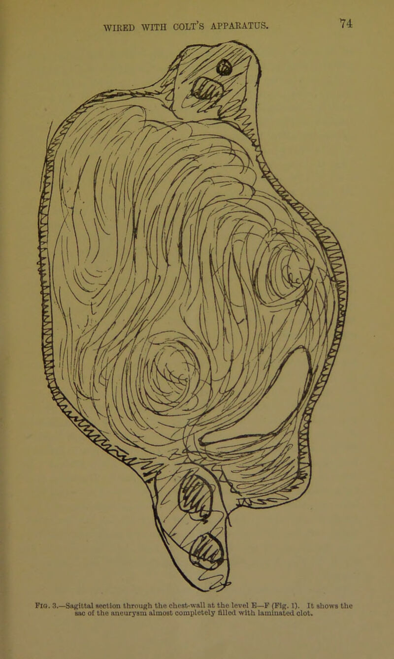 Flo. 3.—Sagittal section through the chest-wall at the level E—F (Fig. 1). It shows the sac of the aneurysm almost completely filled with laminated clot.