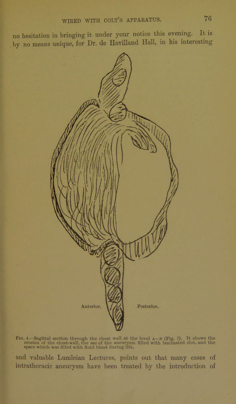 no hesitation in bringing it under your notice this evening. It is by no means unique, for Dr. de Havilland Hall, in his interesting Fio. 4.—Sagittal section through the chest wall at the level A—B (Fig. 1). It shows the erosion of the chest-wall, the sac of the aneurysm filled with laminated clot, and the space which was filled with fluid blood during life. and valuable Lumleian Lectures, points out that many cases of intrathoracic aneurysm have been treated by the introduction of