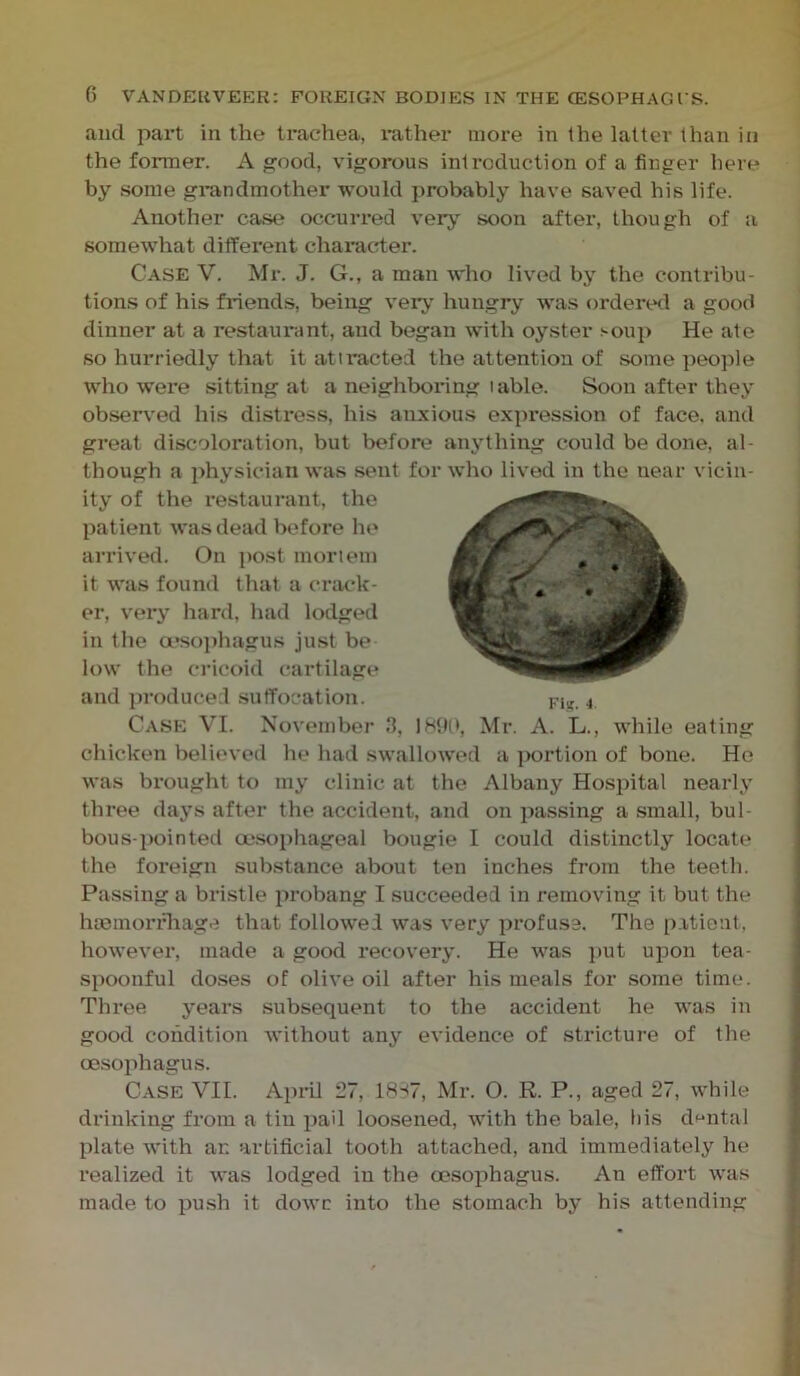 and pai’t in the trachea, i-ather more in the latter than in the former. A good, vigorous introduction of a finger here by some grandmother would probably have saved his life. Another case occurred very soon after, though of a somewhat different character. Case V. Mr. J. G., a man who lived by the contribu- tions of his friends, being veiy hungry was ordered a good dinner at a restaurant, and began with oyster soup He ate so hurriedly that it attracted the attention of some people who were sitting at a neighboring table. Soon after they obsem-ed his distress, his anxious expression of face, and great discoloration, but before anything could be done, al- though a physician was sent for who lived in the near vicin- ity of the restaurant, the patient was dead before he arrived. On post mortem it was found that a crack- er, very hard, had lodged in the a*sophagus just be low the cricoid cartilage and produced .suffocation. , Case VI. November tl, 189(t, Mr. A. L., while eating chicken believed he had swallowed a ]K>rtion of bone. He was brought to my clinic at the Albany Hospital nearly three days after the accident, and on passing a small, bul- bous-pointed oe.sophageal bougie I could distinctly locate the foreign substance about ten inches from the teeth. Passing a bristle i>robang I succeeded in removing it but the hmmoridiage that followed was very profuse. The p.itient. however, made a good recovery. He was jiut upon tea- spoonful doses of olive oil after his meals for some time. Thi’ee years .subsequent to the accident he was in good condition without any evidence of stricture of the oesophagus. Case VII. April 27, 1887, Mr. O. R. P., aged 27, while drinking from a tin pail loosened, with the bale, liis dental plate with at: artificial tooth attached, and immediately he realized it was lodged in the oesophagus. An effort was made to push it dowc into the stomach by his attending