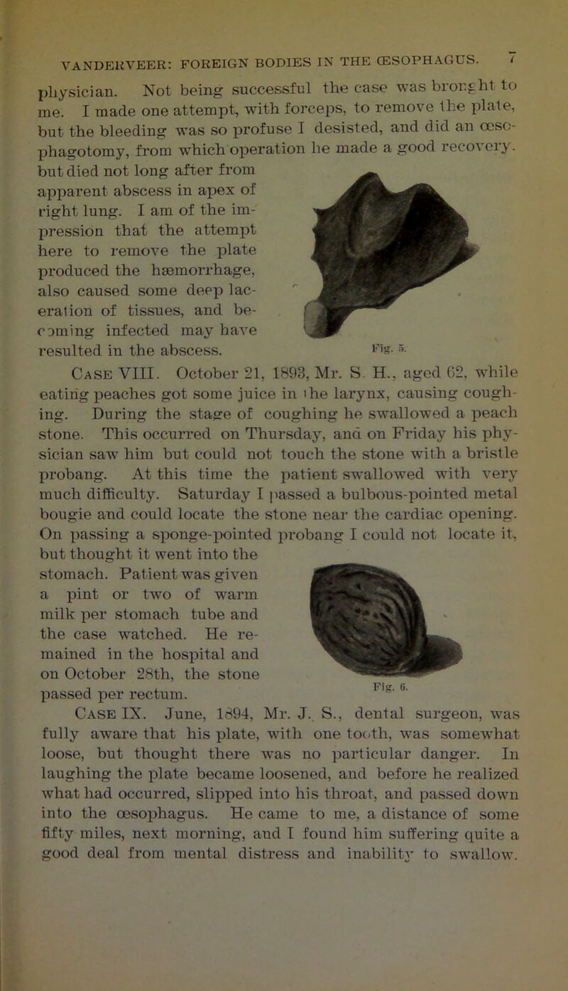 I^hysician. Not being successful the case was brought to me. I made one attempt, with forceps, to remove the plate, but the bleeding was so profuse I desisted, and did an ceso- phagotomy, from which operation he made a good recovery, but died not long after from apparent abscess in apex of right lung. I am of the im- jjression that the attempt here to remove the plate produced the haemorrhage, also caused some deep lac- eration of tissues, and be- cDining infected may have resulted in the abscess. Case VIII. October 21, 1893, Mr. S. H., aged 02, while eating peaches got some juice in the larynx, causing cough- ing. During the stage of coughing he swallowed a peach stone. This occurred on Thursday, and on Friday his iihy- sician saw him but could not touch the stone with a bristle probang. At this time the patient swallowed with very much difficulty. Saturday I passed a bulbous-pointed metal bougie and could locate the stone near the cardiac opening. On passing a sponge-pointed probang I could not locate it, but thought it went into the stomach. Patient was given a pint or two of warm milk per stomach tube and the case watched. He re- mained in the hospital and on October 28th, the stone passed per rectum. Case IX. June, 1894, Mr. J. S., dental surgeon, was fully aware that his plate, with one tooth, was somewhat loose, but thought there was no particular danger. In laughing the plate became loosened, and before he realized what had occurred, slipped into his throat, and passed down into the oesophagus. He came to me, a distance of some fifty miles, next morning, and I found him suffering quite a good deal from mental distress and inability to swallow.