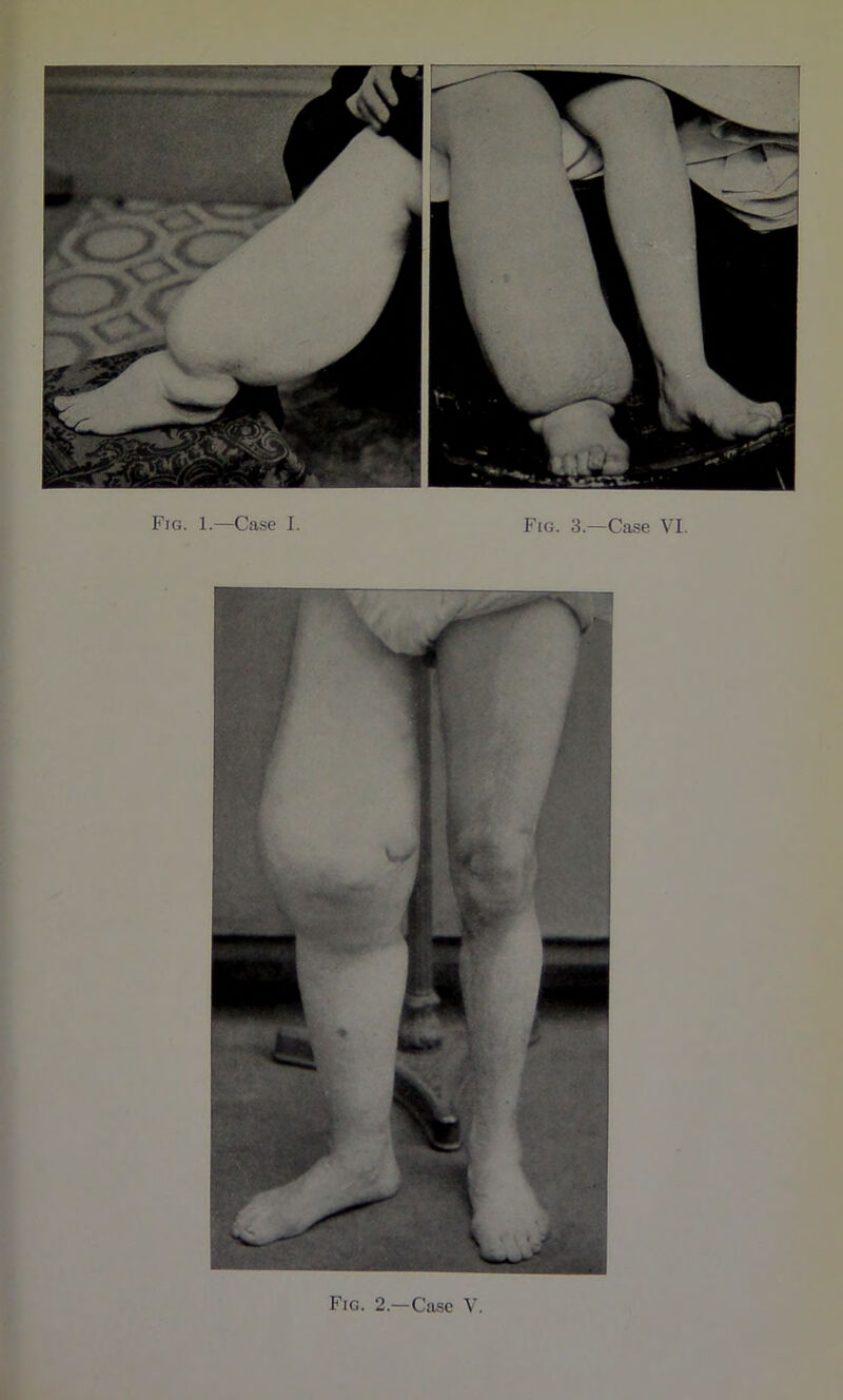 Fig. 1.—Case I. Fig. 3.—Case VI. Fig. 2.—Case V.