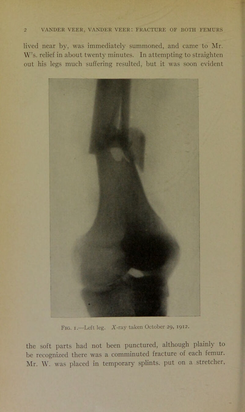 lived near by, was immediately summoned, and came to Mr. W’s. relief in about twenty minutes. In attempting to straighten out his legs much suffering resulted, but it was soon evident Fig. i—Left leg. X-ray taken October 29, 1912. the soft parts had not been punctured, although plainly to be recognized there was a comminuted fracture of each femur. Mr. W. was placed in temporary splints, put on a stretcher.