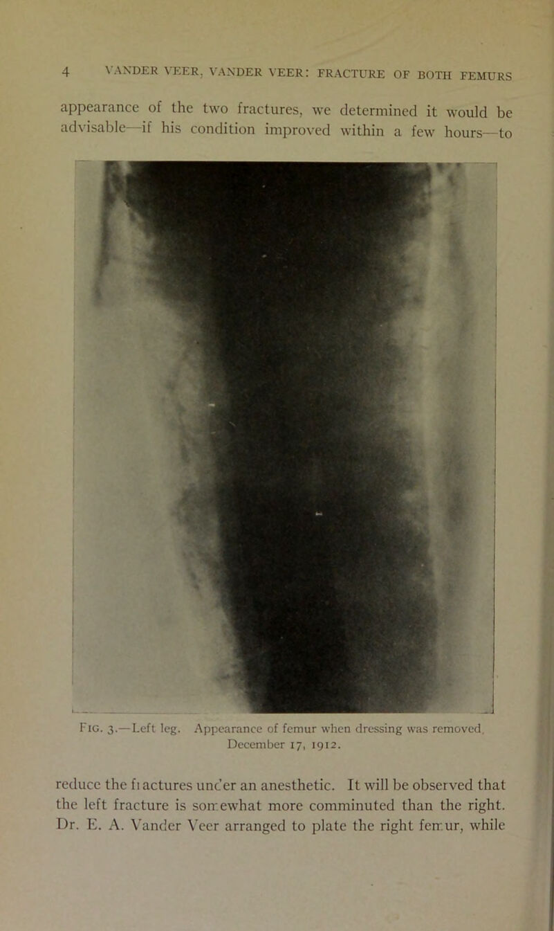 appearance of the two fractures, we determined it would be advisable il his condition improved within a few hours—to Fig. 3.—Left leg. Appearance of femur when dressing was removed. December 17, 1912. reduce the fi actures under an anesthetic. It will be observed that the left fracture is somewhat more comminuted than the right. Dr. E. A. Vander Veer arranged to plate the right femur, while