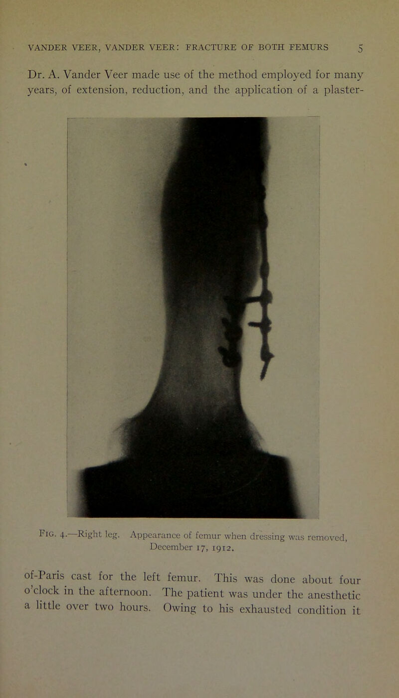 Dr. A. Vander Veer made use of the method employed for many years, of extension, reduction, and the application of a plaster- Fig. 4.—Right leg. Appearance of femur when dressing was removed, December 17, 1912. of-Paris cast for the left femur. This was done about four o clock in the afternoon. The patient was under the anesthetic a little over two hours. Owing to his exhausted condition it