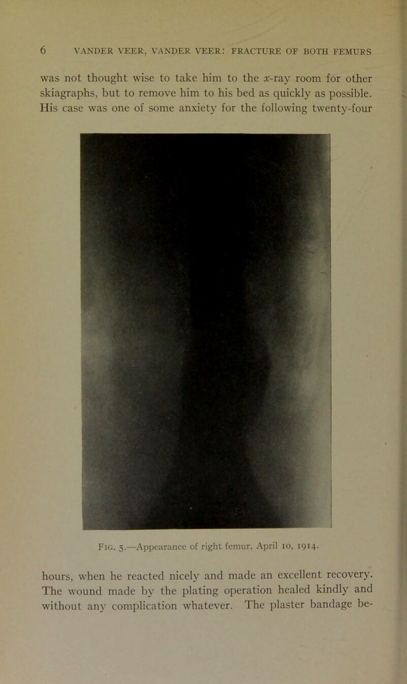 was not thought wise to take him to the *-ray room for other skiagraphs, but to remove him to his bed as quickly as possible. His case was one of some anxiety for the following twenty-four I'ig. 5.—Appearance of right femur, April 10, 1914. hours, when he reacted nicely and made an excellent recovery. The wound made by the plating operation healed kindly and without any complication whatever. The plaster bandage be-