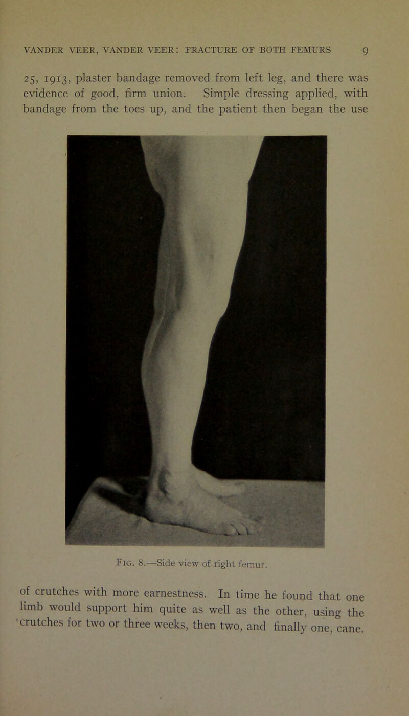 25, 1913, plaster bandage removed from left leg, and there was evidence of good, firm union. Simple dressing applied, with bandage from the toes up, and the patient then began the use Fig. 8.—Side view of right femur. of crutches with more earnestness. In time he found that one limb would support him quite as well as the other, using the crutches for two or three weeks, then two, and finally one, cane.