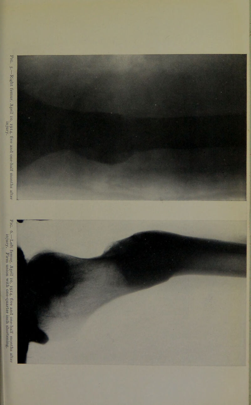 Pic;. 5.—Right femur, April 10, 1914. five and one-half months after Fig. 6.—Left femur, April 10, 1914, five and one-half months after injury. injury. Firm union with one-quarter inch shortening.