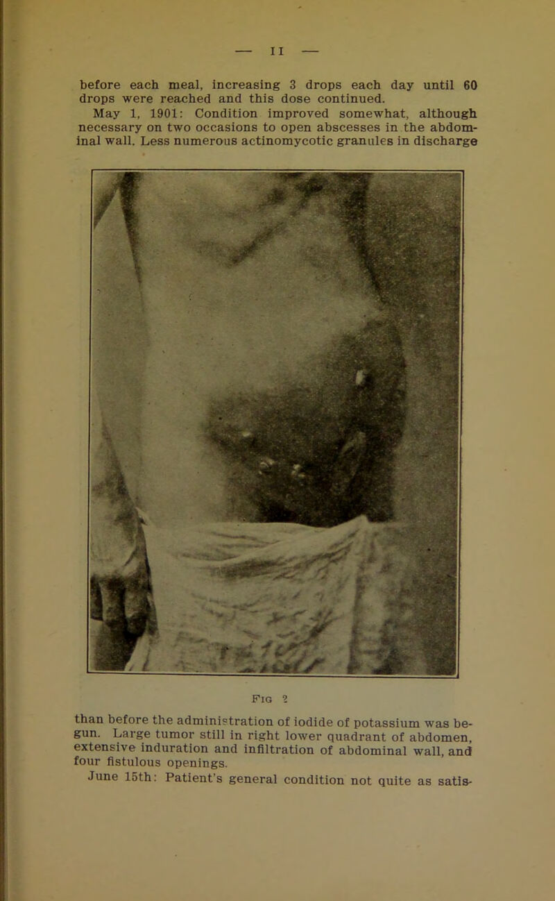 before each meal, increasing 3 drops each day until 60 drops were reached and this dose continued. May 1, 1901: Condition improved somewhat, although necessary on two occasions to open abscesses in the abdom- inal wall. Less numerous actinomycotic granules in discharge Fig 1 than before the administration of iodide of potassium was be- gun. Large tumor still in right lower quadrant of abdomen, extensive induration and infiltration of abdominal wall, and four fistulous openings. June 15th: Patient’s general condition not quite as satis-