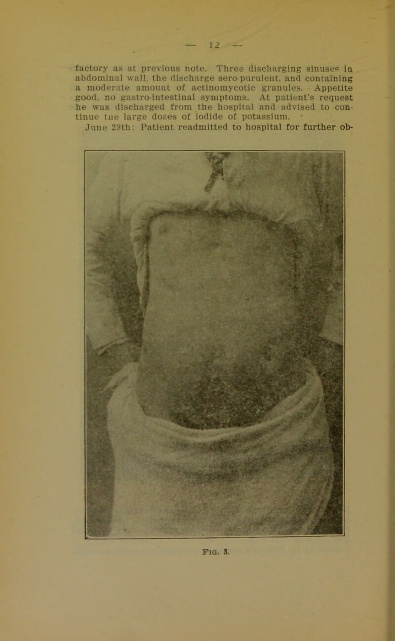 I 2 factory as at previous note. Three discharging sinuses in abdominal wall, the discharge sero purulent. and containing a moderate amount of actinomycotic granules. Appetite good, no gastro-intestinal symptoms. At patient’s request he was discharged from the hospital and advised to con- tinue tne large doses of iodide of potassium. June 29tb: Patient readmitted to hospital for further ob-