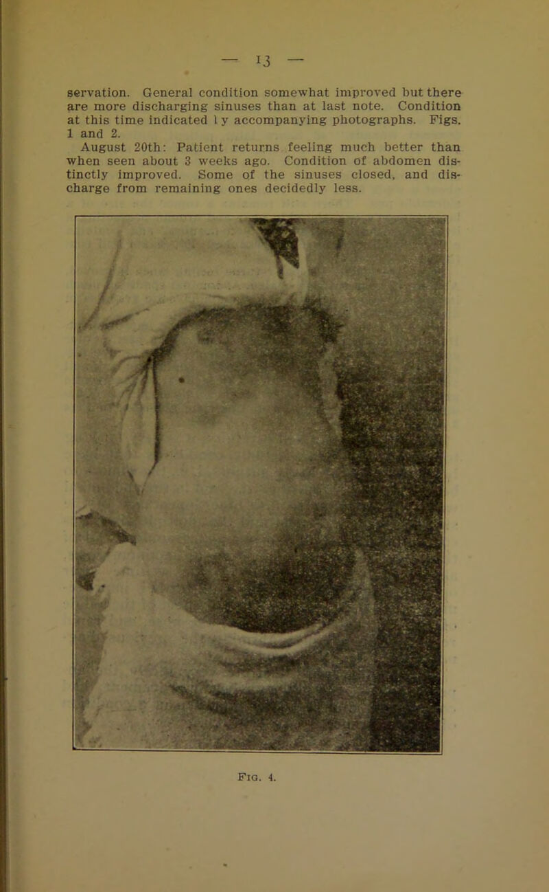 *3 servation. General condition somewhat improved but there are more discharging sinuses than at last note. Condition at this time indicated 1 y accompanying photographs. Figs. 1 and 2. August 20th: Patient returns feeling much better than when seen about 3 weeks ago. Condition of abdomen dis- tinctly improved. Some of the sinuses closed, and dis- charge from remaining ones decidedly less.