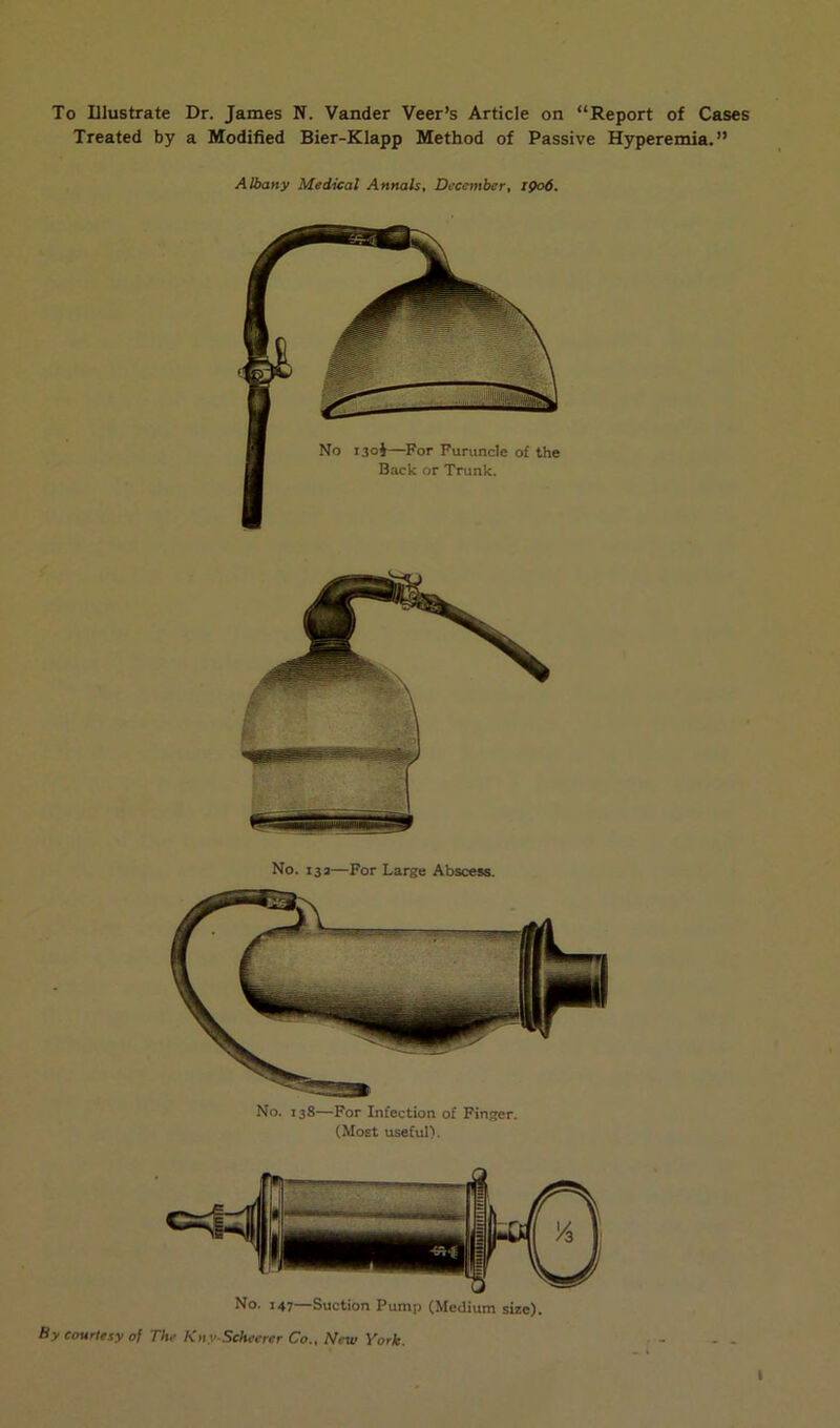 To Illustrate Dr. James N. Vander Veer’s Article on “Report of Cases Treated by a Modified Bier-Klapp Method of Passive Hyperemia.” Albany Medical Annals, December, 1906. No. 138—For Infection of Finger. (Most useful). No. 147—Suction Pump (Medium size). By courtesy of Tlte Kny-Scheerer Co., New York. I