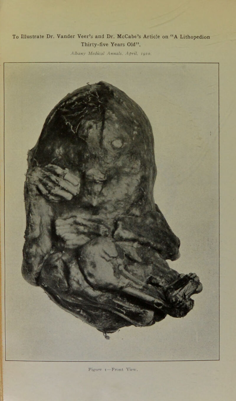 To Illustrate Dr. Vander Veer’s and Dr. McCabe’s Article on “A Lithopedion Thirty-five Years Old”. Albany Medical Annals. April, lyio.