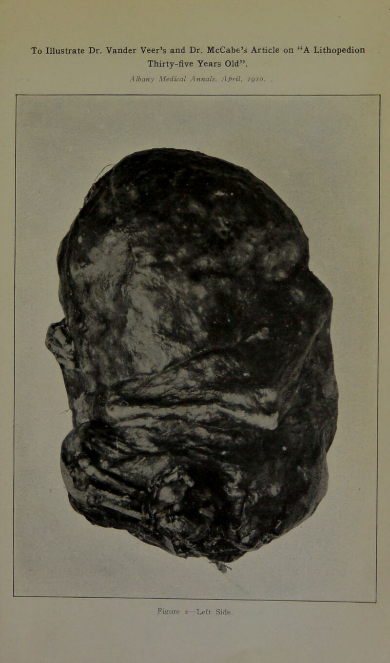 To Illustrate Dr. Vander Veer’s and Dr. McCabe’s Article on “A Lithopedion Thirty-five Years Old”. Albany Medical Annals. April, iqio.