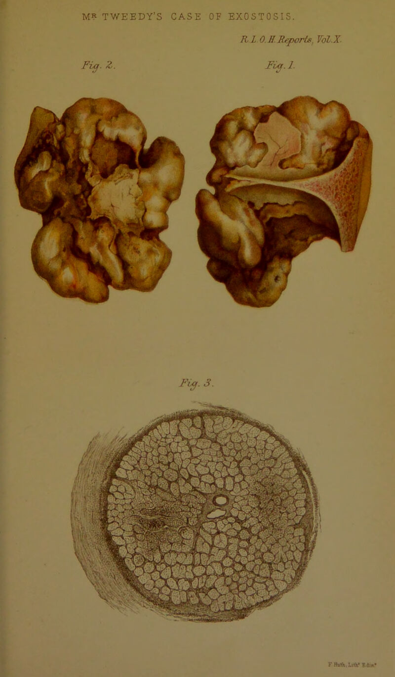 MR TWEEDY’S CASE OF EXOSTOSIS. K L O.H. Reports, Vol.X. Pip. Z. Fi^. 1. Ftp,. 3. FHnth.LiUi'Edm’