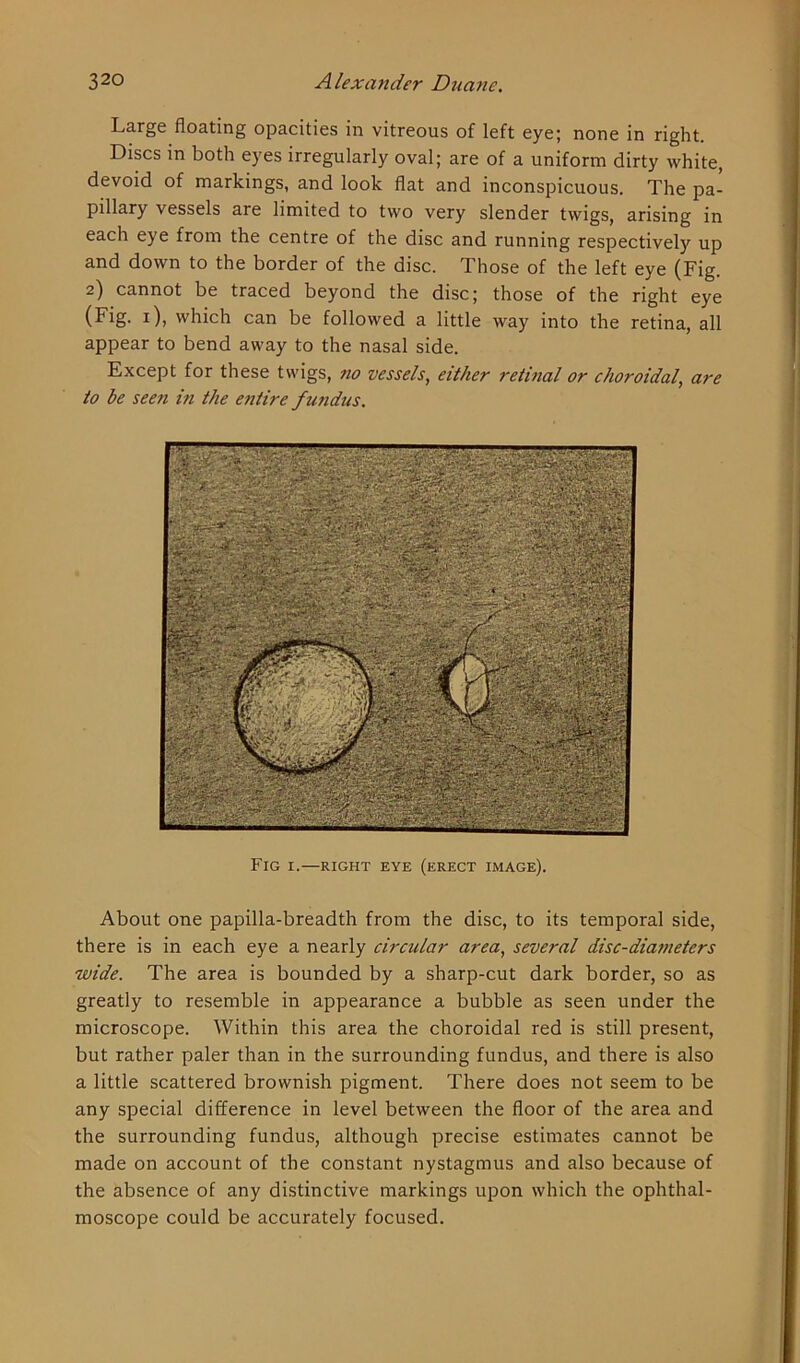 Large floating opacities in vitreous of left eye; none in right. Discs in both eyes irregularly oval; are of a uniform dirty white, devoid of markings, and look flat and inconspicuous. The pa- pillary vessels are limited to two very slender twigs, arising in each eye from the centre of the disc and running respectively up and down to the border of the disc. Those of the left eye (Fig. 2) cannot be traced beyond the disc; those of the right eye (Fig. 1), which can be followed a little way into the retina, all appear to bend away to the nasal side. Except for these twigs, no vessels, either retinal or choroidal, are to be seen in the entire fundus. Fig 1.—right eye (erect image). About one papilla-breadth from the disc, to its temporal side, there is in each eye a nearly circular area, several disc-diameters wide. The area is bounded by a sharp-cut dark border, so as greatly to resemble in appearance a bubble as seen under the microscope. Within this area the choroidal red is still present, but rather paler than in the surrounding fundus, and there is also a little scattered brownish pigment. There does not seem to be any special difference in level between the floor of the area and the surrounding fundus, although precise estimates cannot be made on account of the constant nystagmus and also because of the absence of any distinctive markings upon which the ophthal- moscope could be accurately focused.