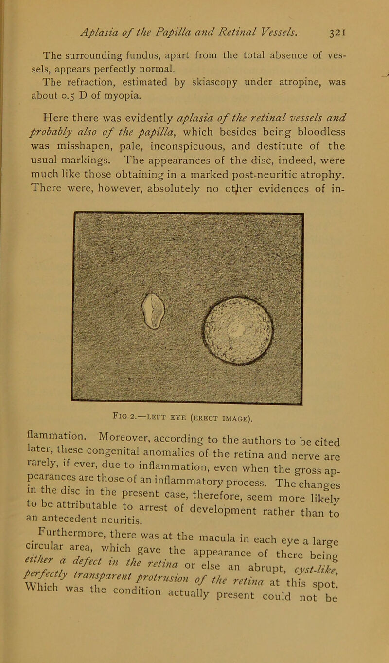 The surrounding fundus, apart from the total absence of ves- sels, appears perfectly normal. The refraction, estimated by skiascopy under atropine, was about 0.5 D of myopia. Here there was evidently aplasia of the retinal vessels and probably also of the papilla, which besides being bloodless was misshapen, pale, inconspicuous, and destitute of the usual markings. The appearances of the disc, indeed, were much like those obtaining in a marked post-neuritic atrophy. There were, however, absolutely no ot^her evidences of in- Fig 2-—left eye (erect image). flammation. Moreover, according to the authors to be cited ater, these congenital anomalies of the retina and nerve are rarely, if ever, due to inflammation, even when the gross ap- pearances are those of an inflammatory process. The changes “ ^!SC. T Present case. therefore, seem more likely an *l t0 arreSt °f deveI°Pment tether than to an antecedent neuritis. Furthermore, there was at the macula in each eye a laroe c r u,ar area, which gave the appearance of there being I II1. d‘ftCt m the rltina or else an abrupt, cyst-like ff f traK*Par‘«* protrusion of the retina at this spot’ winch was the condition actually present could not be