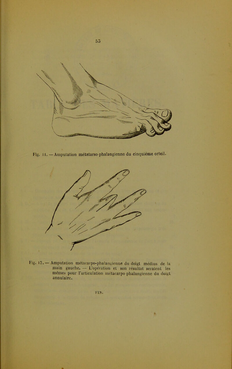 Fig. 11. — Amputation métatarso-phalangienne du cinquième orteil. Fig. 12.—Amputation métacarpo-phalangienne du doigt médius de la main gauche. — L’opération eL son résultat seraient les mêmes pour l’articulation métacarpo phalangiennc du doigt annulaire. Kl N.